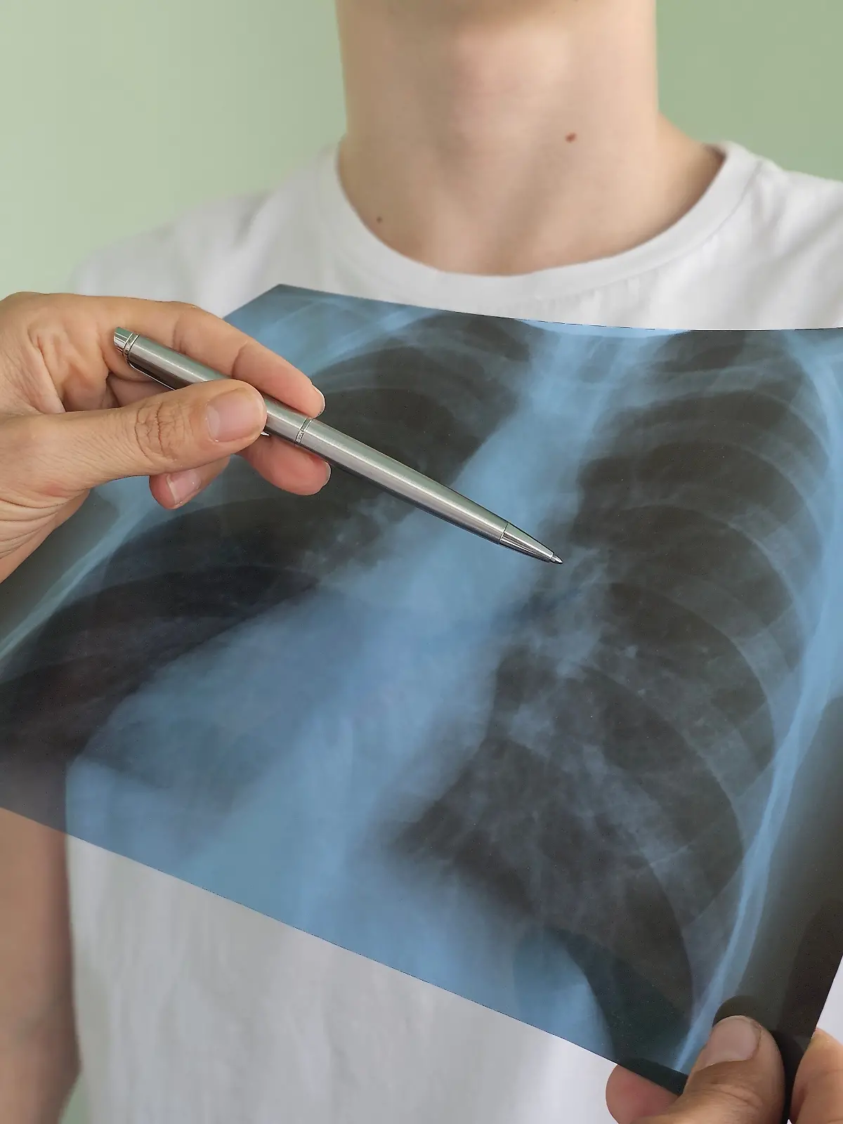 Wie funktioniert eine Lungentransplantation?