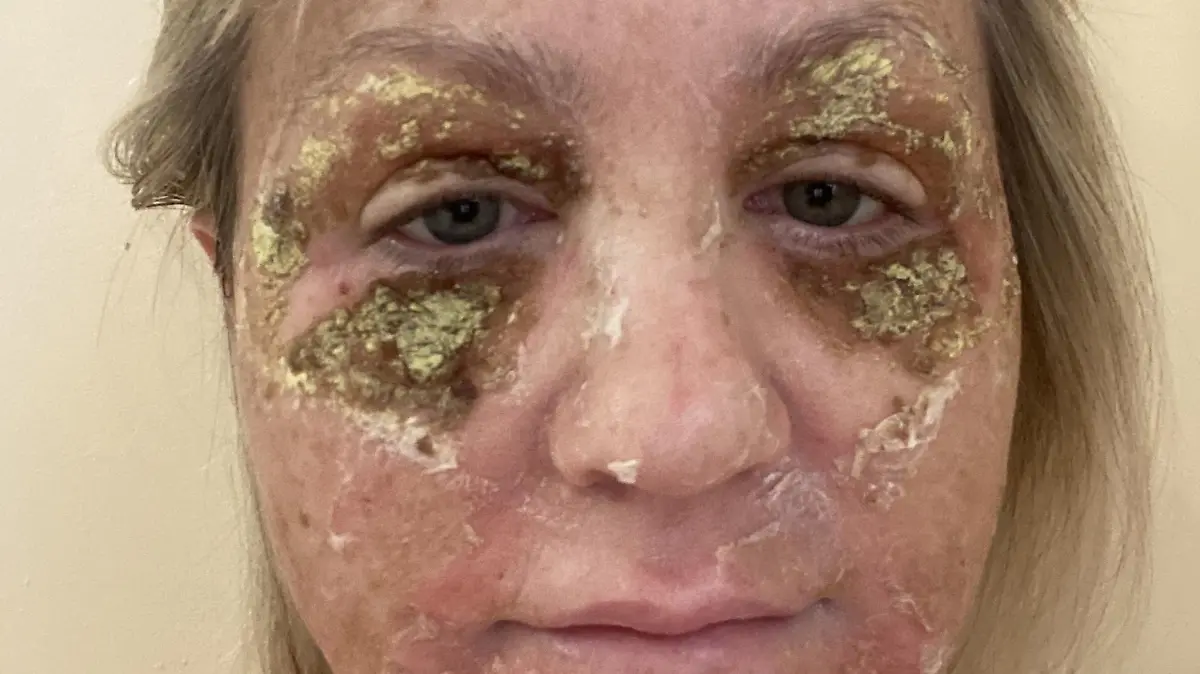Amanda Watkins kurz nach ihrem chemischen Peeling. Ihre Haut schuppt sich vom Gesicht.