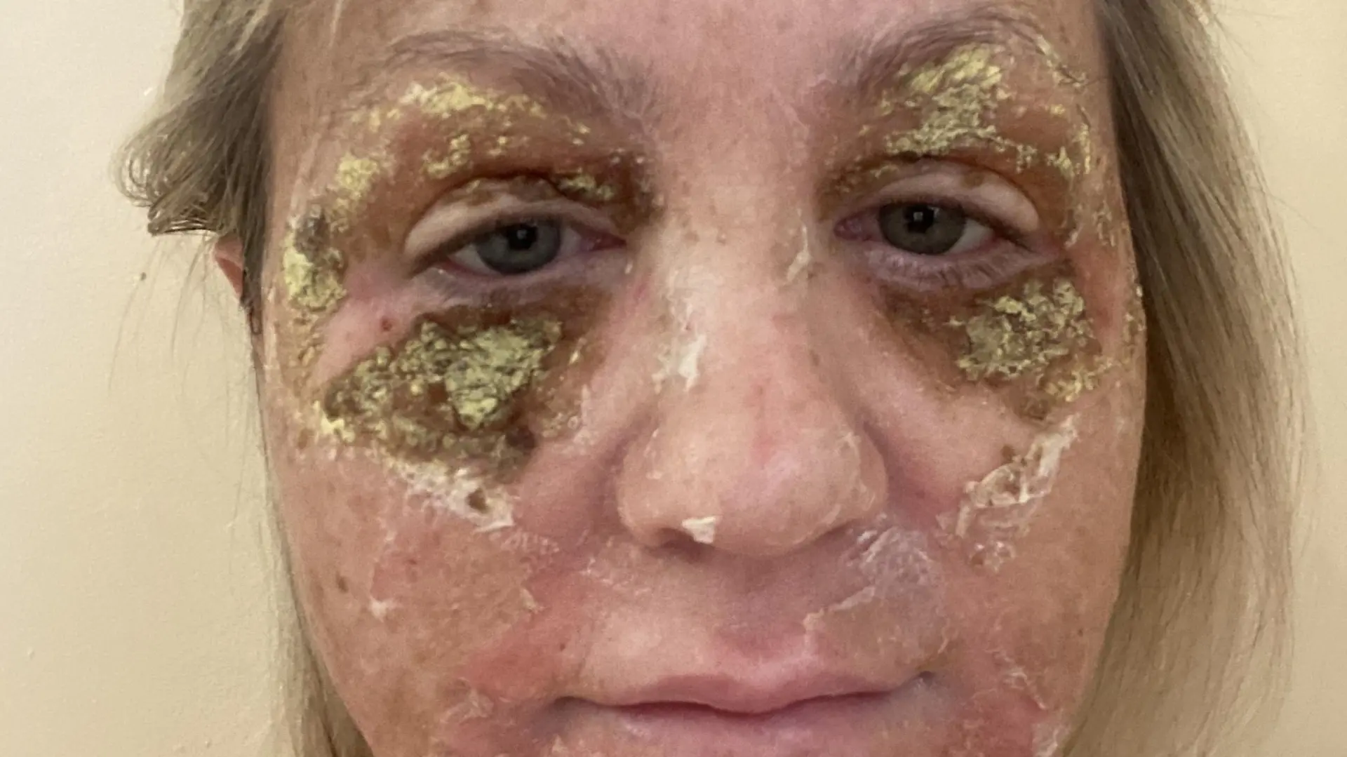 Amanda Watkins kurz nach ihrem chemischen Peeling. Ihre Haut schuppt sich vom Gesicht.