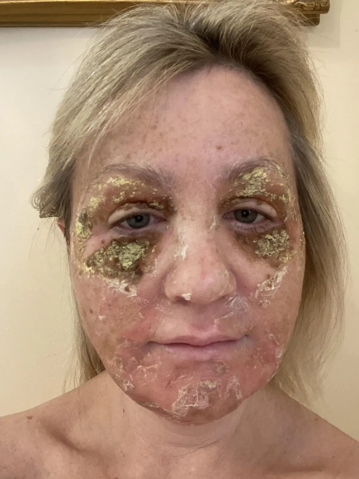 Amanda Watkins kurz nach ihrem chemischen Peeling. Ihre Haut schuppt sich vom Gesicht.