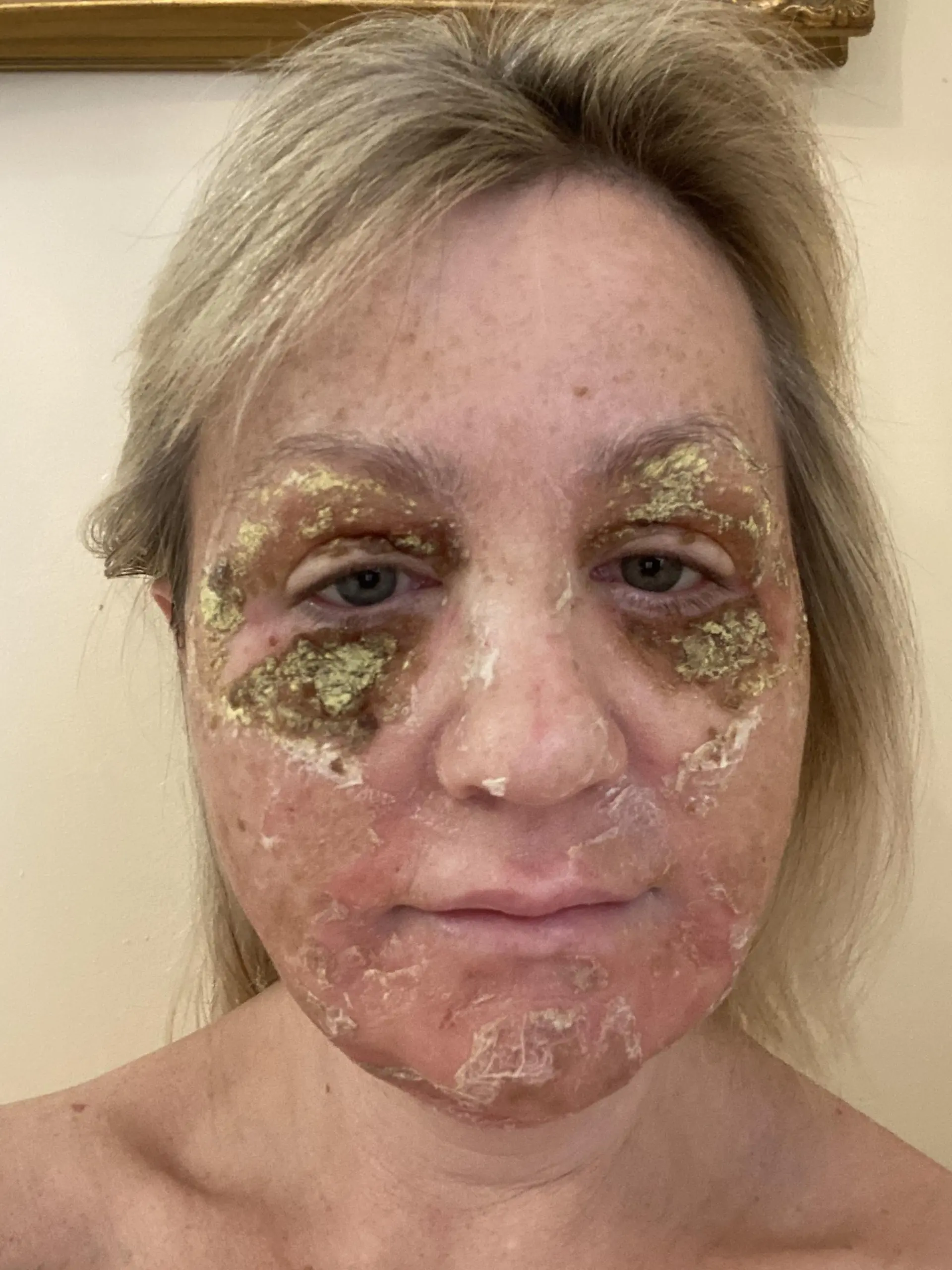 Amanda Watkins kurz nach ihrem chemischen Peeling. Ihre Haut schuppt sich vom Gesicht.