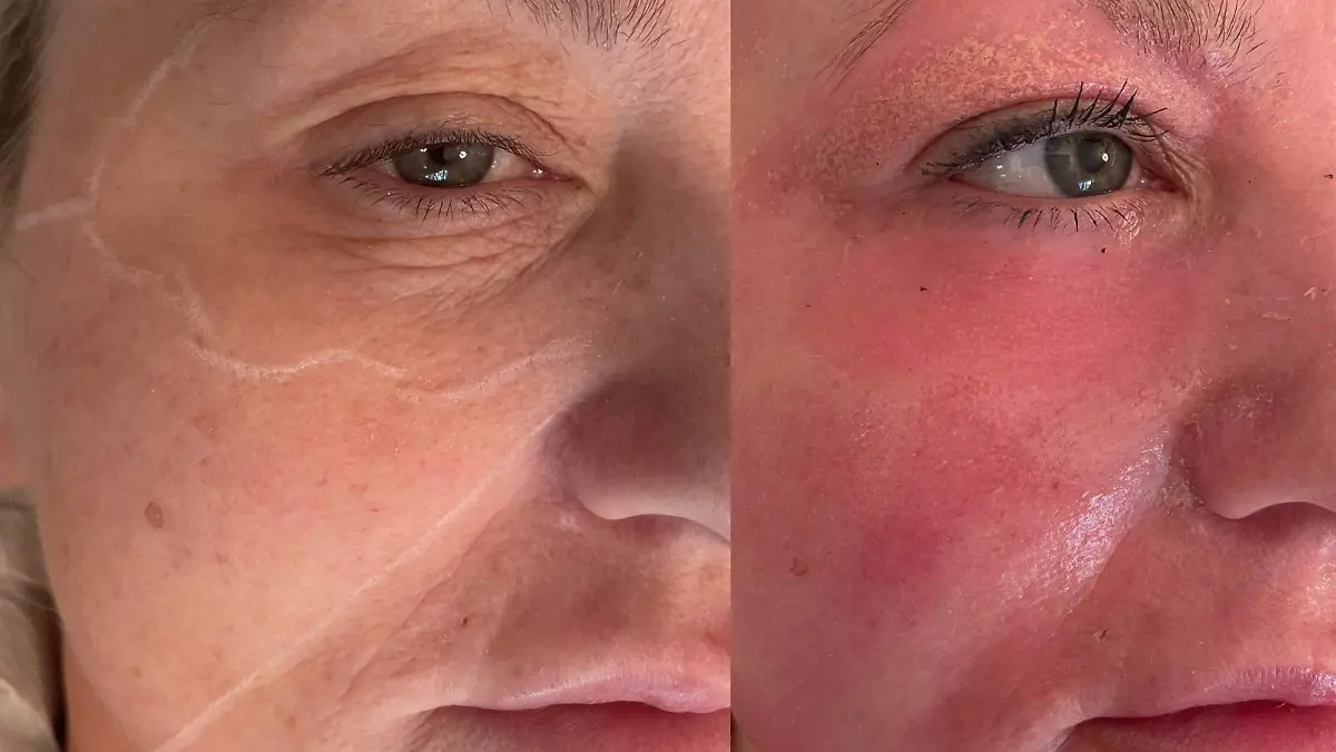 Amanda Watkins kurz nach ihrem chemischen Peeling. Ihre Haut schuppt sich vom Gesicht.