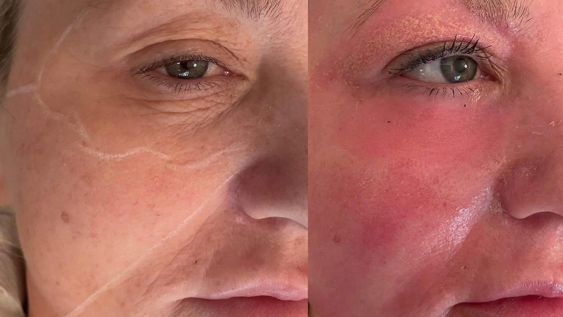 Amanda Watkins kurz nach ihrem chemischen Peeling. Ihre Haut schuppt sich vom Gesicht.