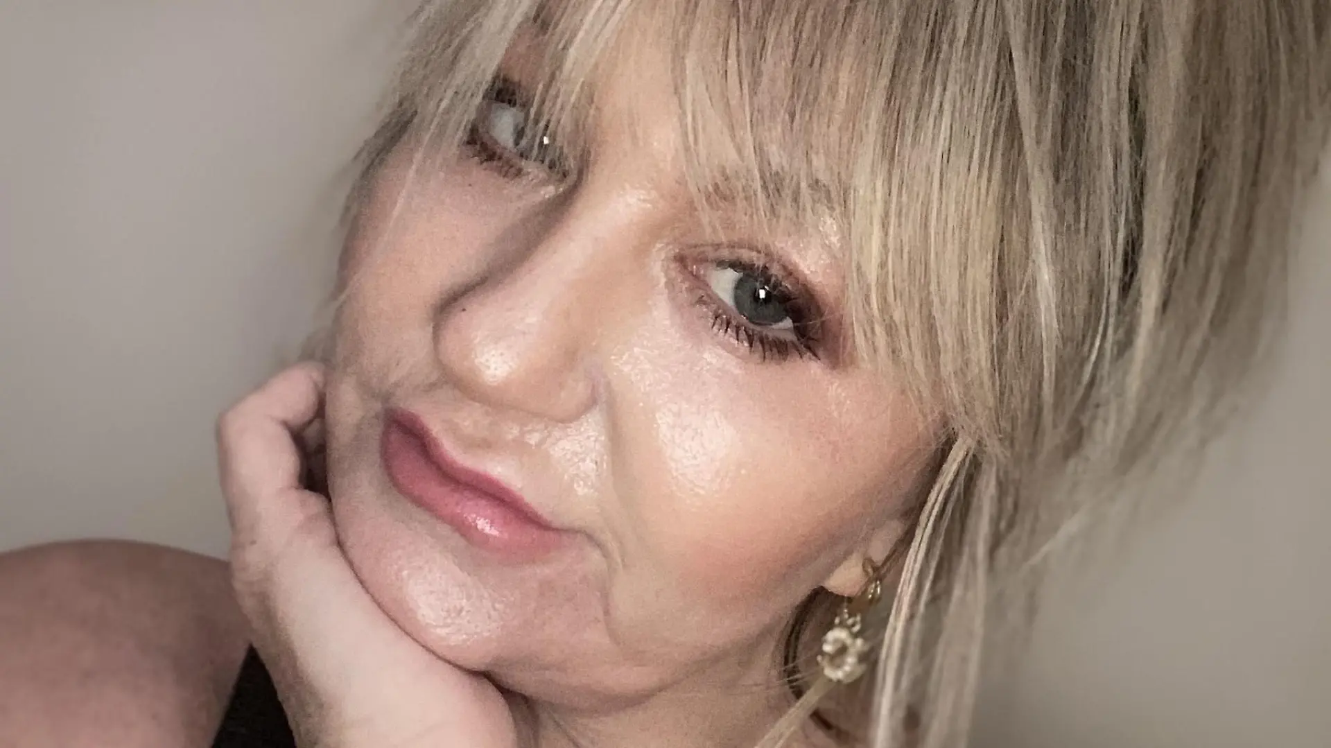 Amanda Watkins kurz nach ihrem chemischen Peeling. Ihre Haut schuppt sich vom Gesicht.