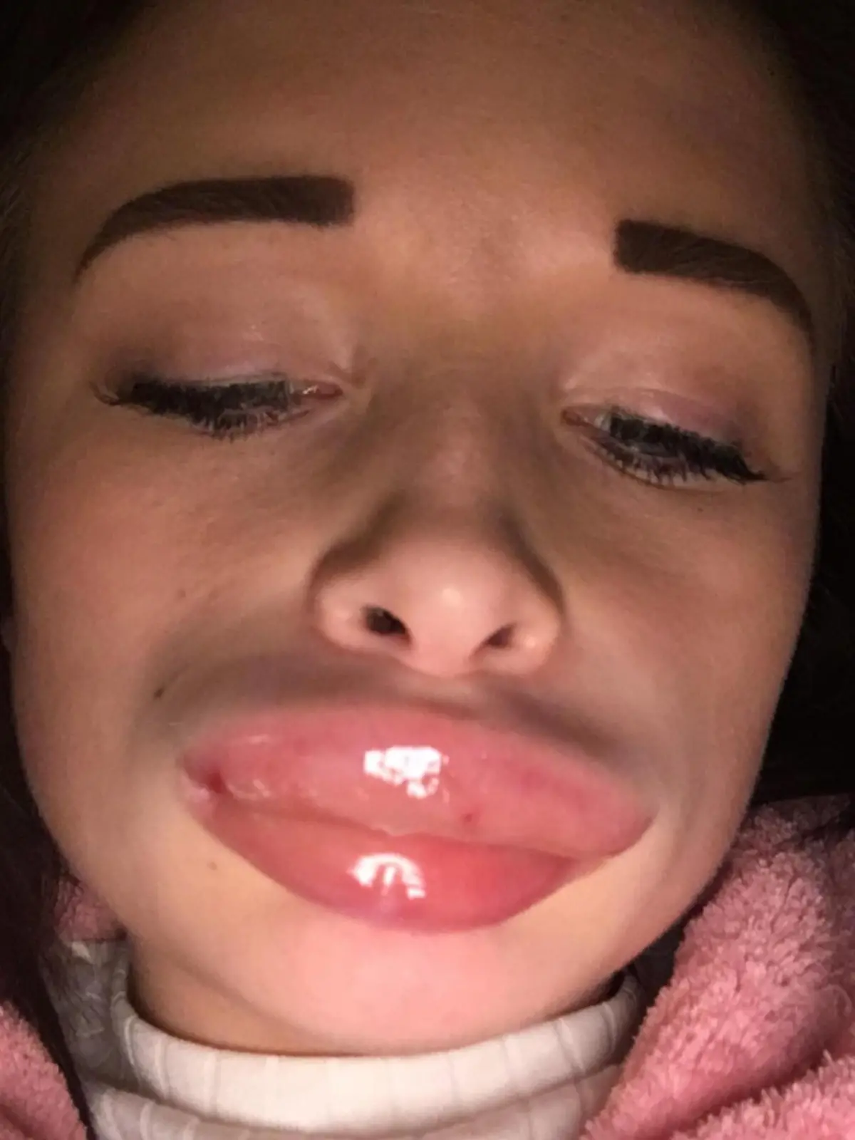 PIC FROM Kennedy News and Media (PICTURED: BILLIE ROOCROFT'S LIPS SWELLING UP ON THE DAY SHE HAD LIP FILLERS DONE BY BELISSIMO RIVINGTON AESTHETICS AT HER HOME) A nurse claims a lip filler treatment left her lips so swollen she looked like ‘The Elephant Man’ – leaving her toddler terrified of her. Billie Roocroft, 23, had never been happy with her ‘thin’ lips and, inspired by celebs flaunting fuller pouts, decided to take the plunge and get fillers. The mum-of-one claims the £120 offer for 1ml of filler administered in her living room by a mum and daughter from Belissimo Rivington Aesthetics resulted in an A&E visit after her lips doubled in size. SEE KENNEDY NEWS COPY - 0161 697 4266