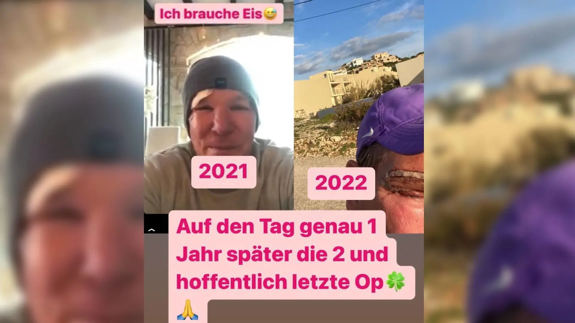 Auf Instagram zeigt Steff Jerkel seine frische OP-Narbe über dem Auge.