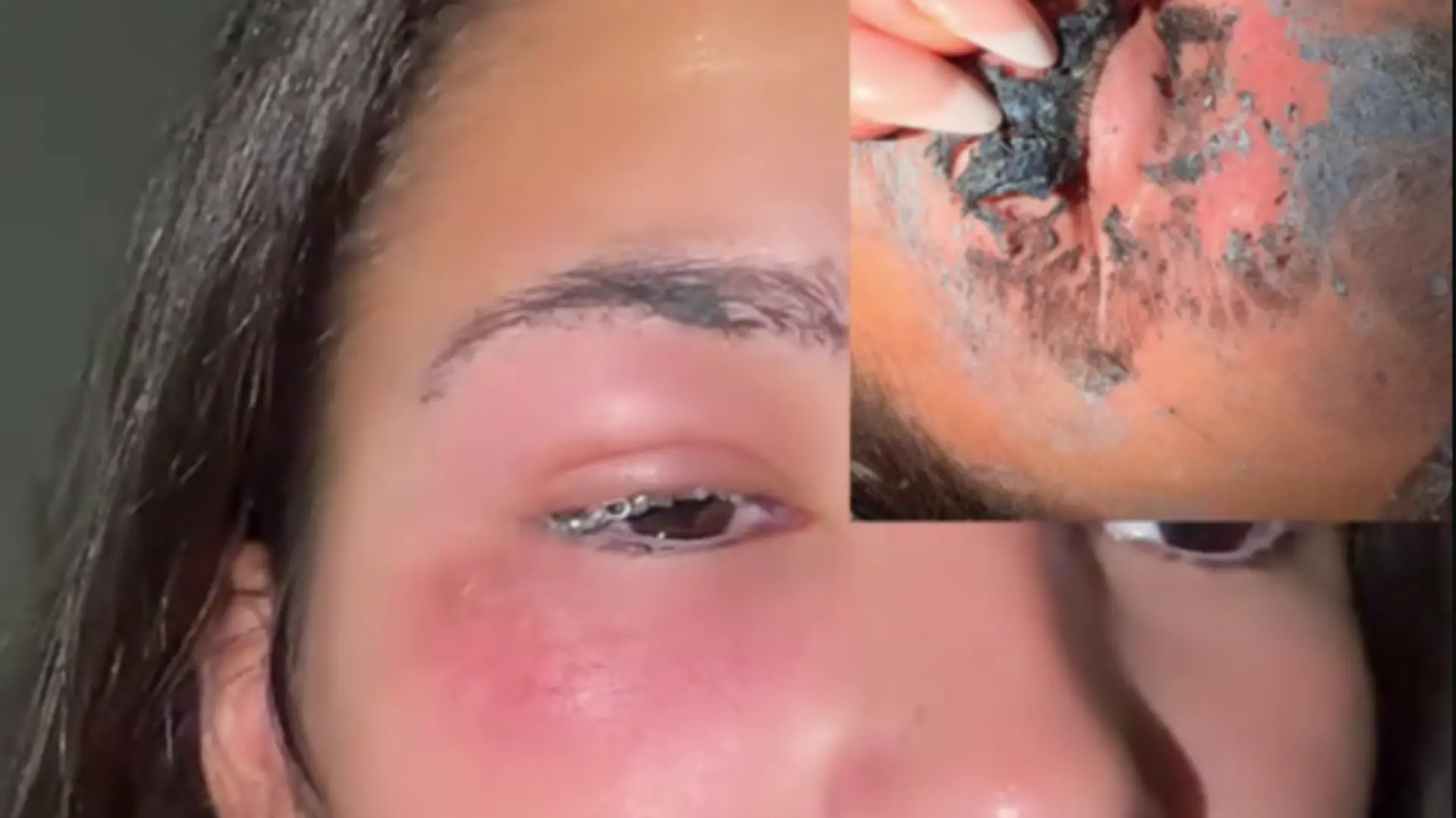 Wimpern-Kleber von SHEIN hinterlässt chemische Verbrennungen