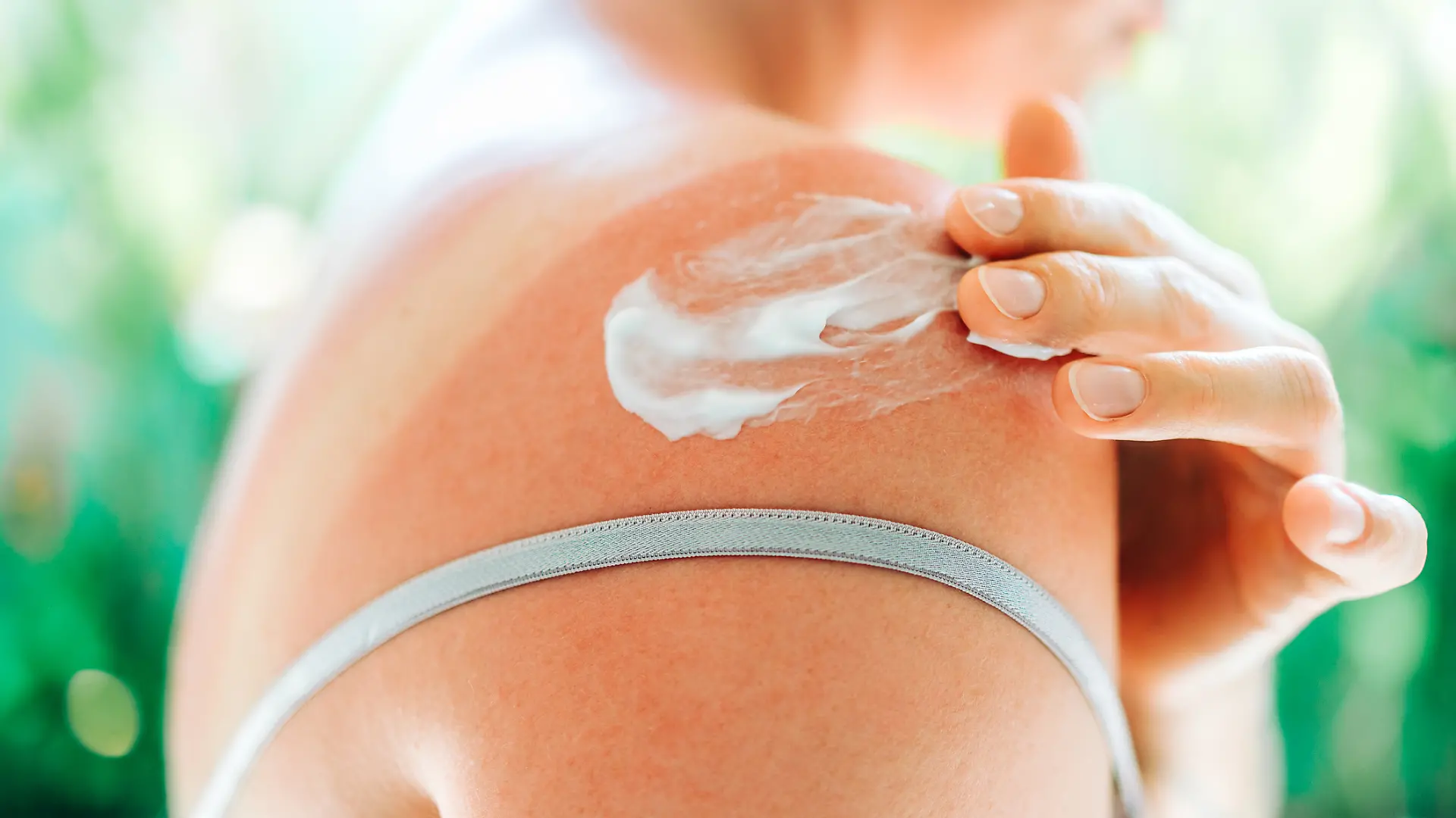 Frau trägt After-Sun-Lotion auf der Schulter auf.