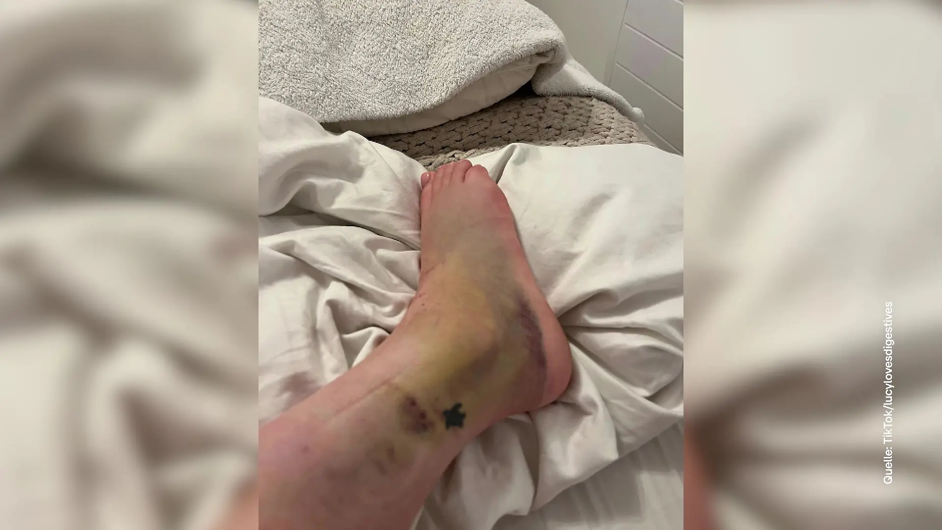 Unfall Zara Hose: Viele posten Bilder ihrer Verletzungen im Netz.