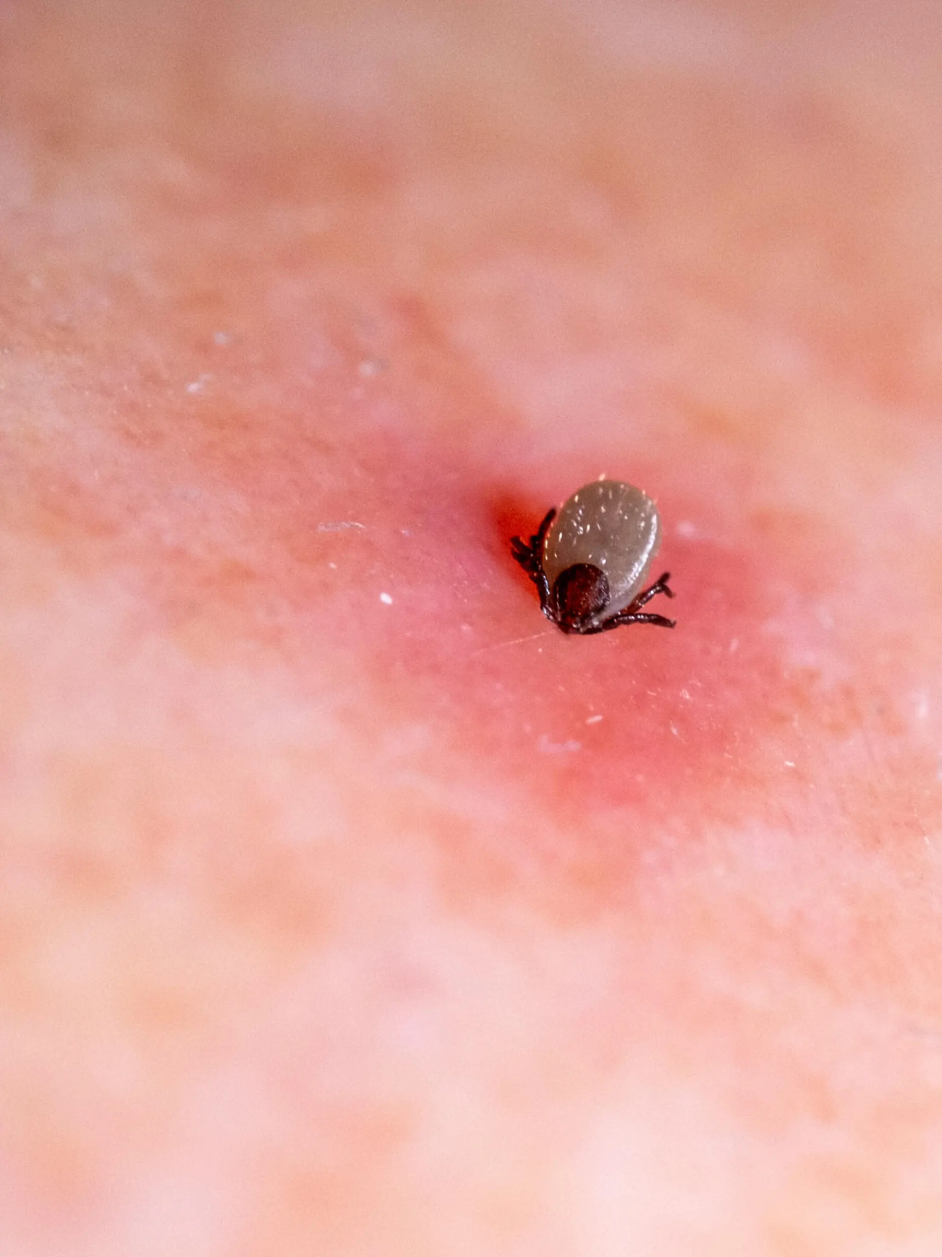 Blutsaugende Zecke auf geröteter Haut. Dir Krankheitsübertragung durch eine Zecke, wie hier der Gemeine Holzbock, kann Krankheiten wie FSME oder Borreliose zu Folge haben.