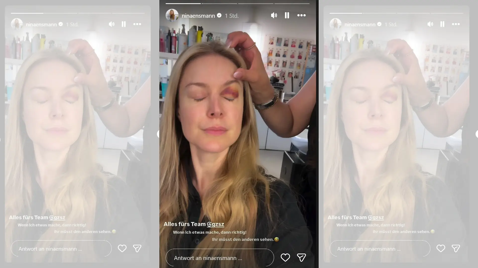 In ihrer Instagram-Story zeigt sich Nina Ensmann aus der GZSZ-Maske mit einem blauen Auge.