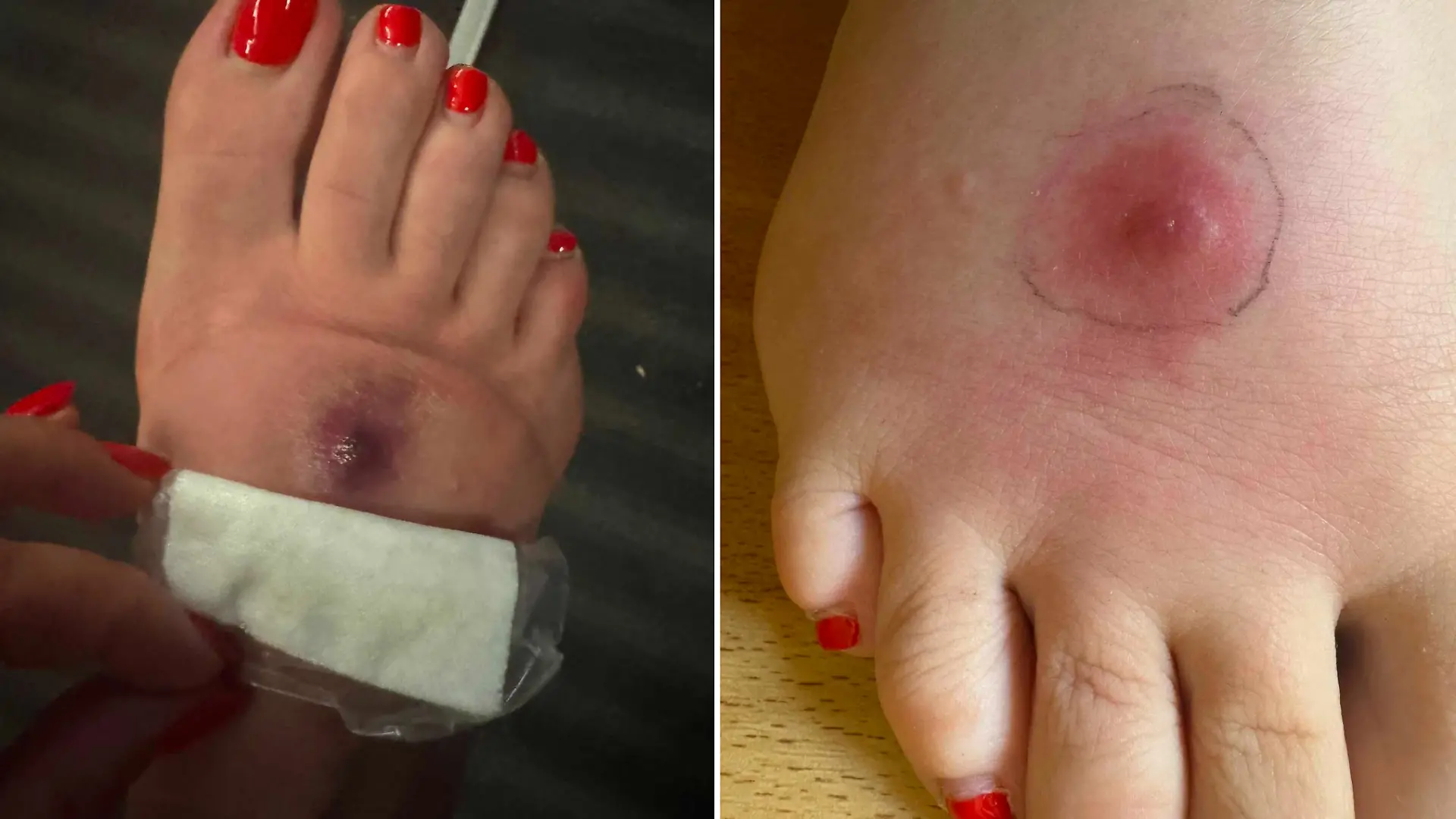 Bei Instagram zeigt Sarah Knappik ihren geschwollenen Fuß.