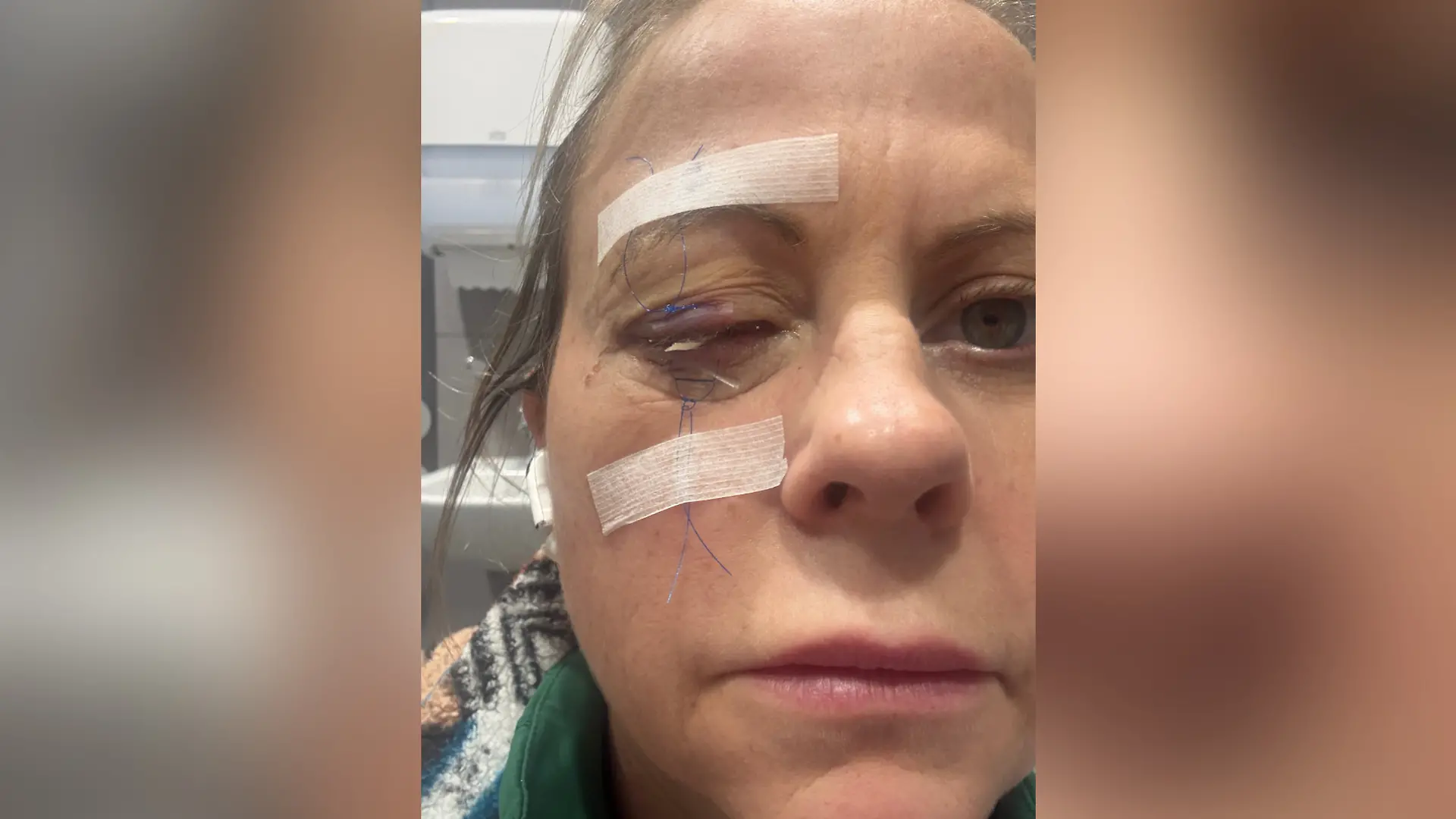Nachdem die Ärzte Emmas Auge behandelt haben, wurde es für den Heilungsprozess vorübergehend zugenäht.