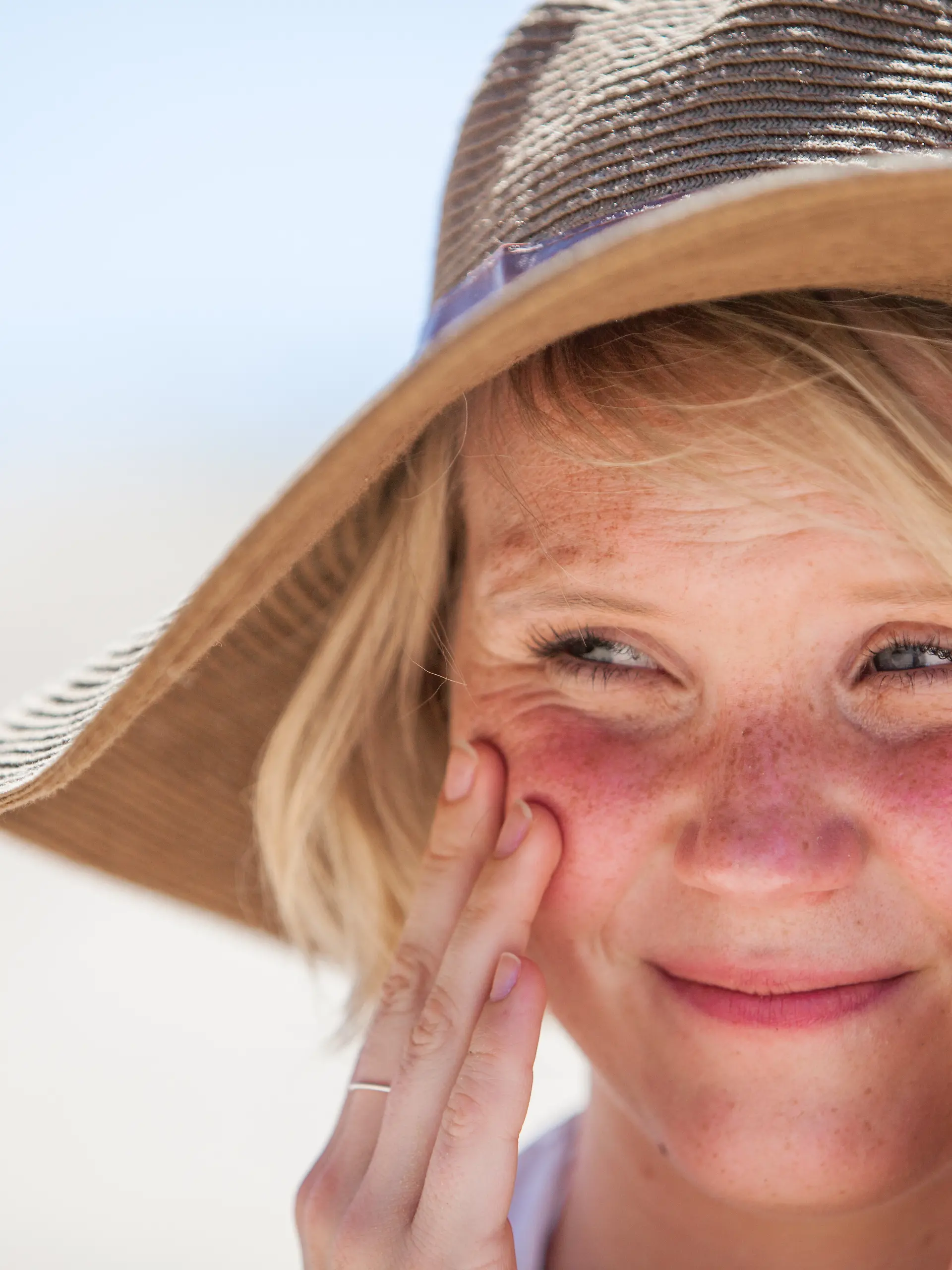 Auf TikTok verbreitet sich der Trend „Cute Sunburn”.