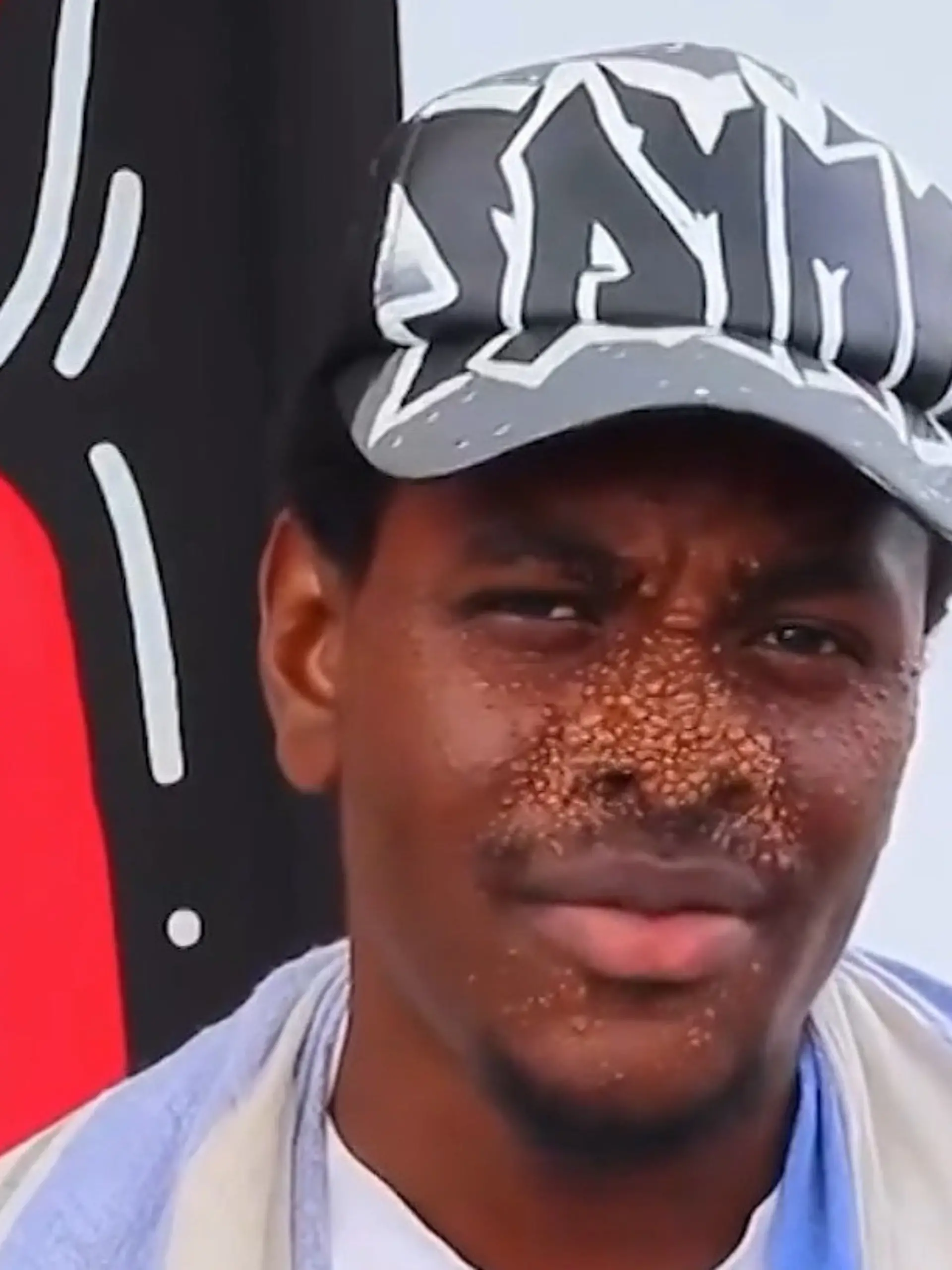 Bild zu: "Hunderte Tumore im Gesicht! Joseph (21) will über seltene Krankheit aufklären"