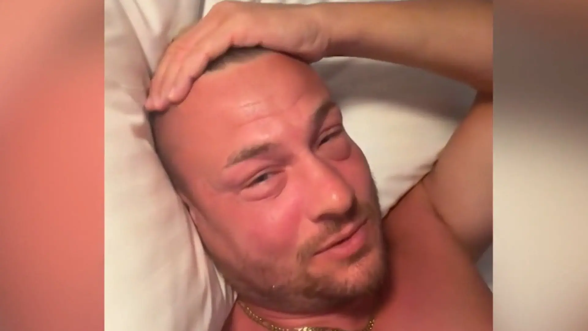 Kaum wiederzuerkennen! Gesicht von Reaity-Star Eric Sindermann komplett angeschwollen Was ist denn da los?