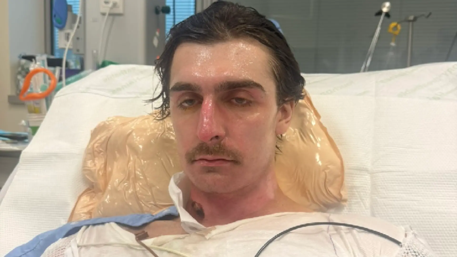 Lachie Perrem erlitt bei der Explosion schwere Verbrennungen an rund 75 Prozent seines Körpers. Seine Familie berichtet inzwischen von ersten Fortschritten.