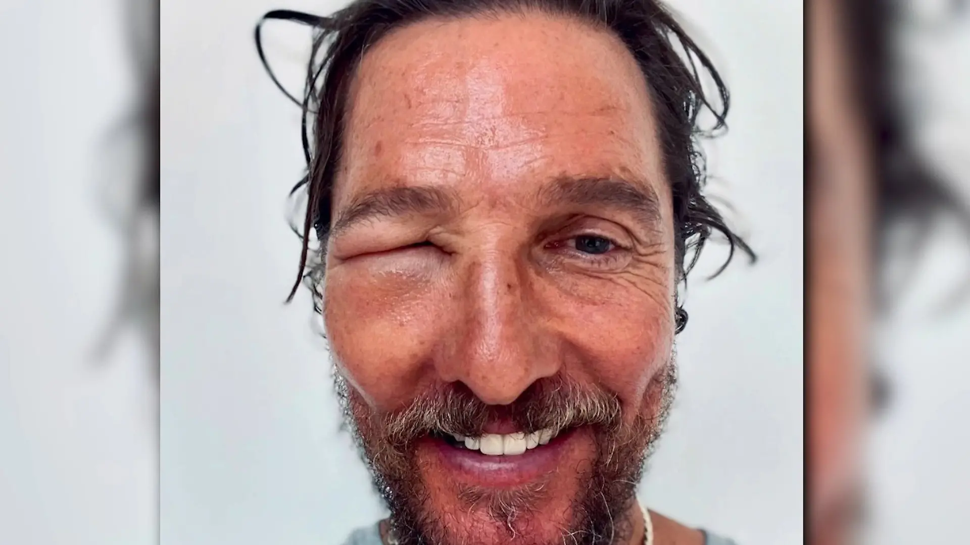 Tier-Attacke auf Hollywood-Star! Gesicht von Schauspieler total entstellt Während Dreharbeiten