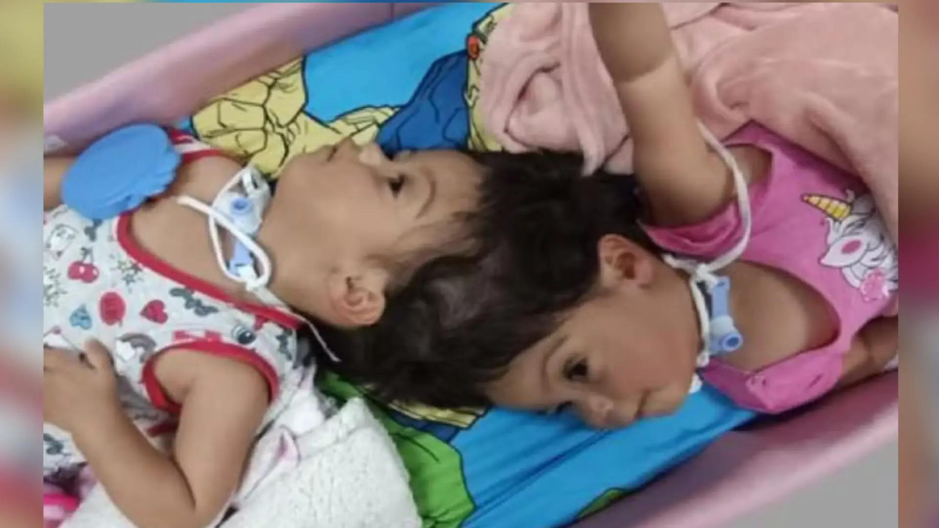 Die siamesischen Zwillinge Helena und Heloísa aus Brasilien überleben die Trennung nicht.
