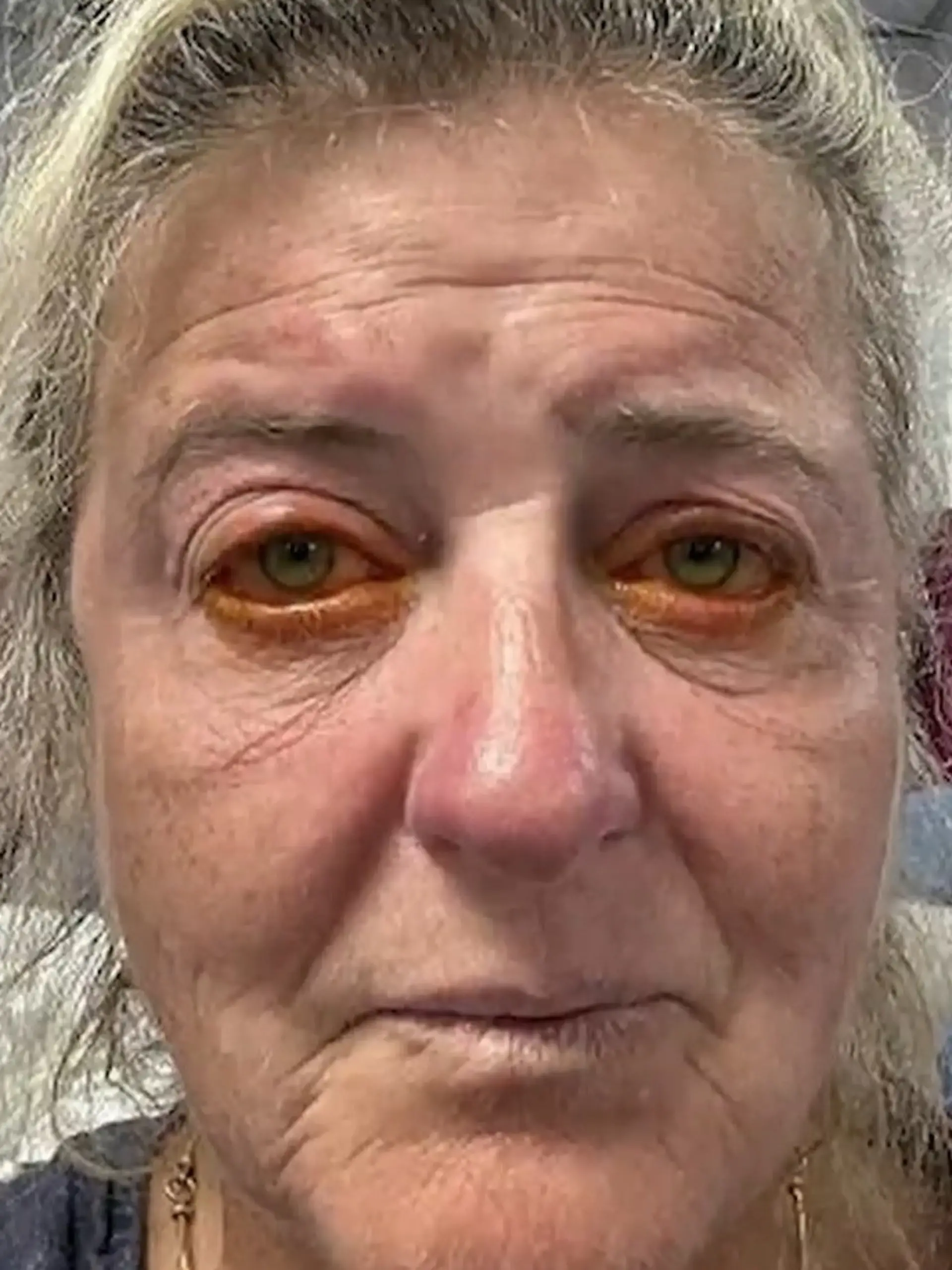 Bild zu: "Fast blind wegen Kontaktlinsen! Schock-Diagnose für Susannah im Krankenhaus"