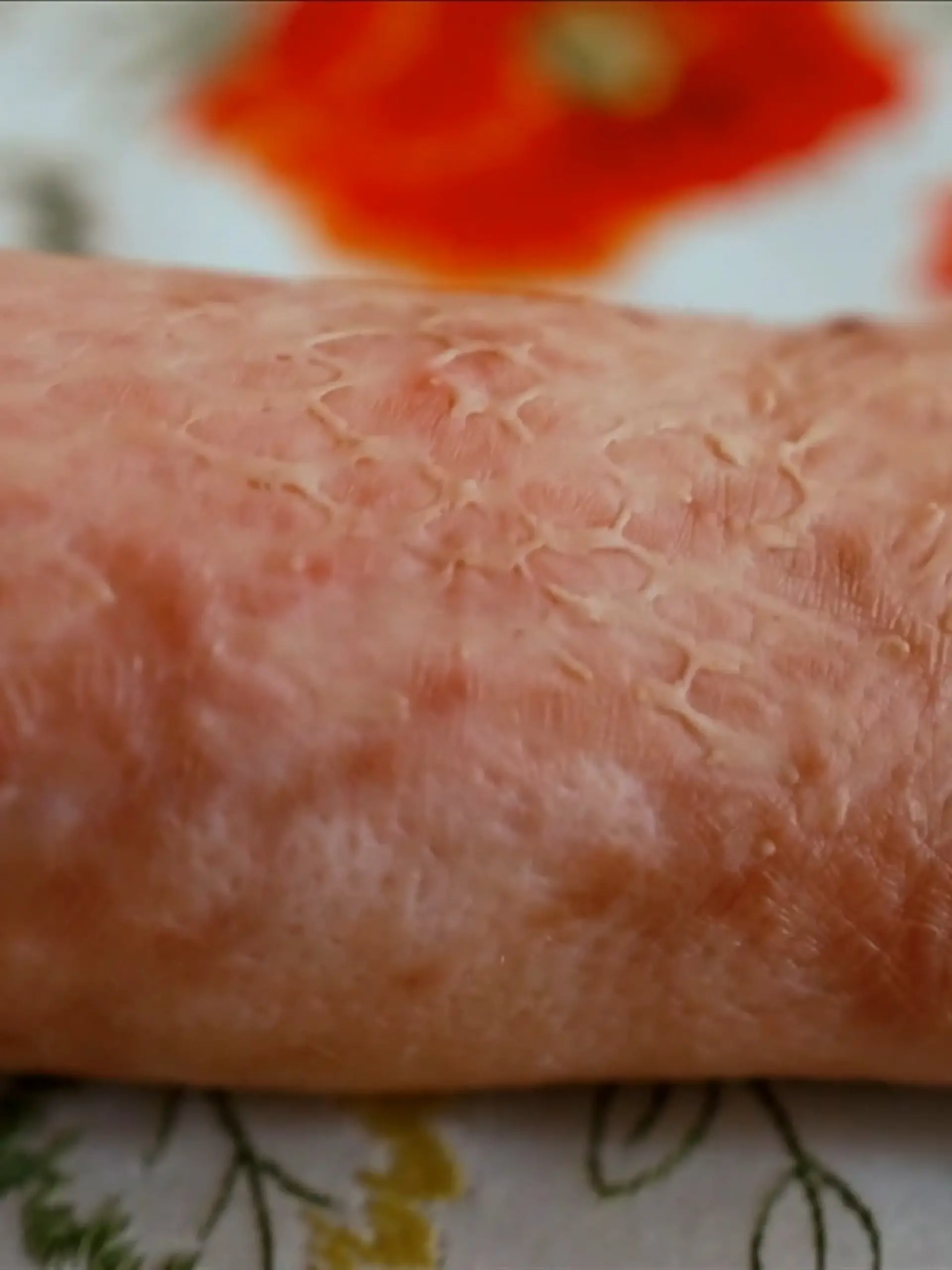 Bild zu: "Fischhaut-Transplantation"