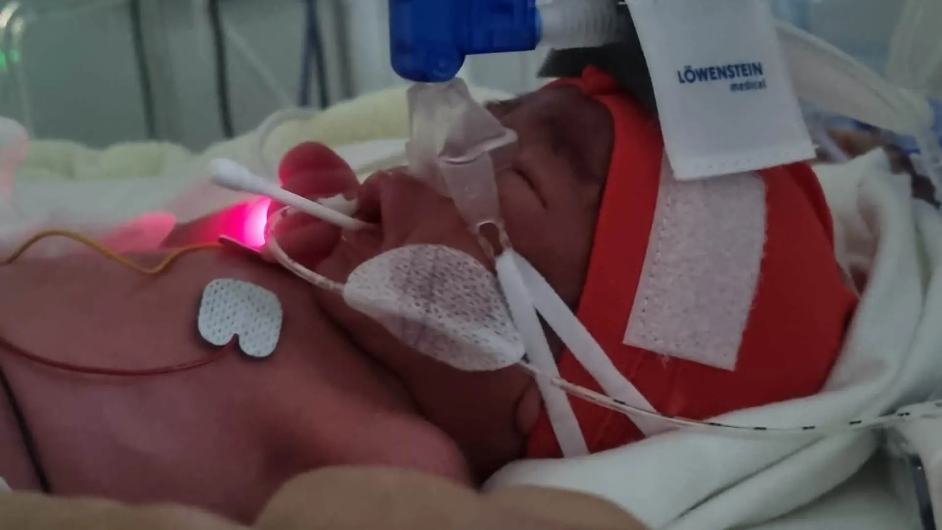 Das neugeborene Baby Jace kämpft um sein Leben