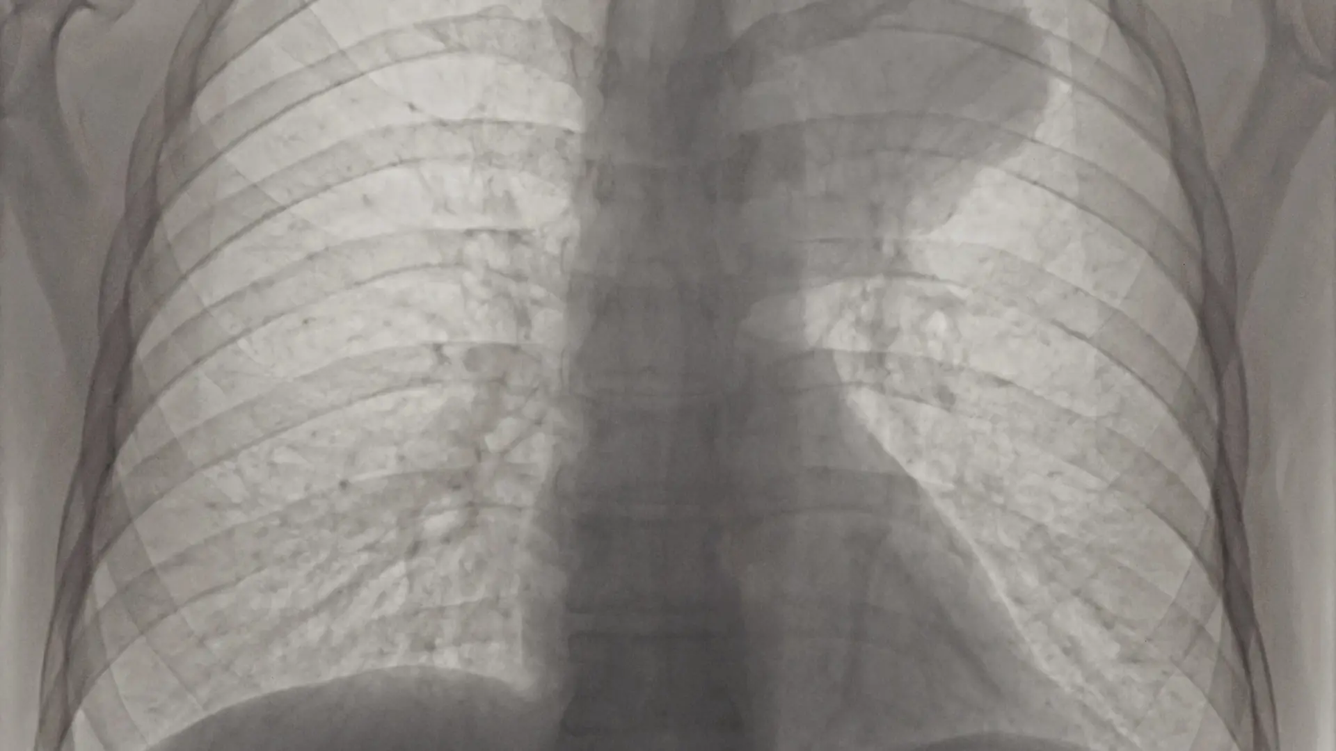 Negativiertes Roentgenbild eines ausgedehnten, kleinzelligen Bronchialkarzinoms im oberen linken Lungenfeld. R = rechte Seite vom Patienten, Inversion of x-ray photo of a small-cell lung cancer in the upper field of left lung, R = right side of patient.
