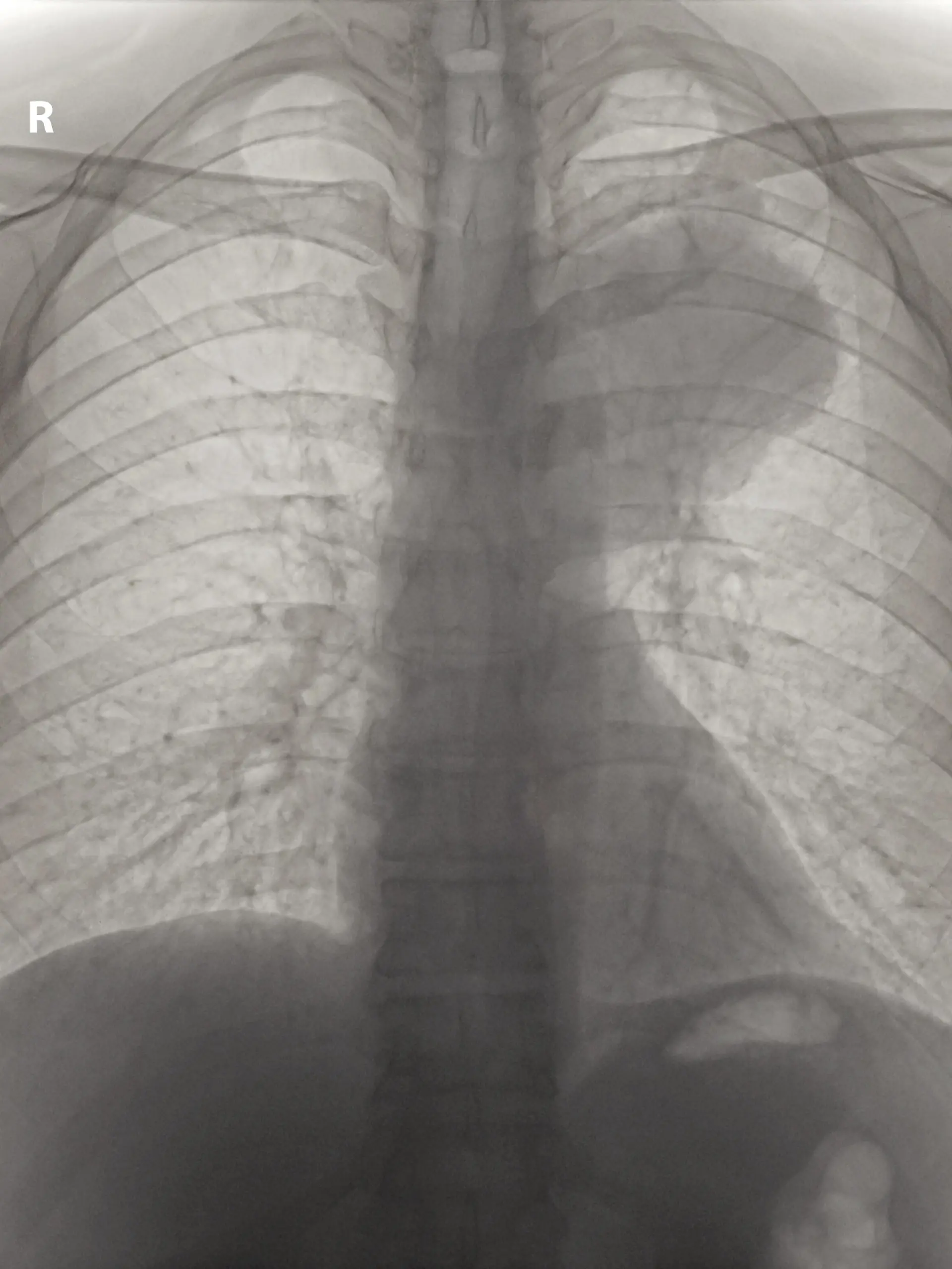Negativiertes Roentgenbild eines ausgedehnten, kleinzelligen Bronchialkarzinoms im oberen linken Lungenfeld. R = rechte Seite vom Patienten, Inversion of x-ray photo of a small-cell lung cancer in the upper field of left lung, R = right side of patient.