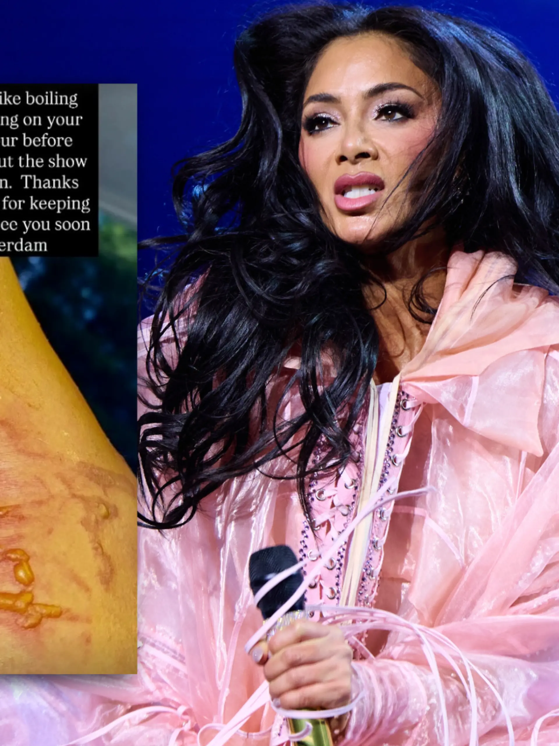 Bild zu: "Mit kochendem Wasser verbrüht! Nicole Scherzinger zeigt schlimme Verletzung"