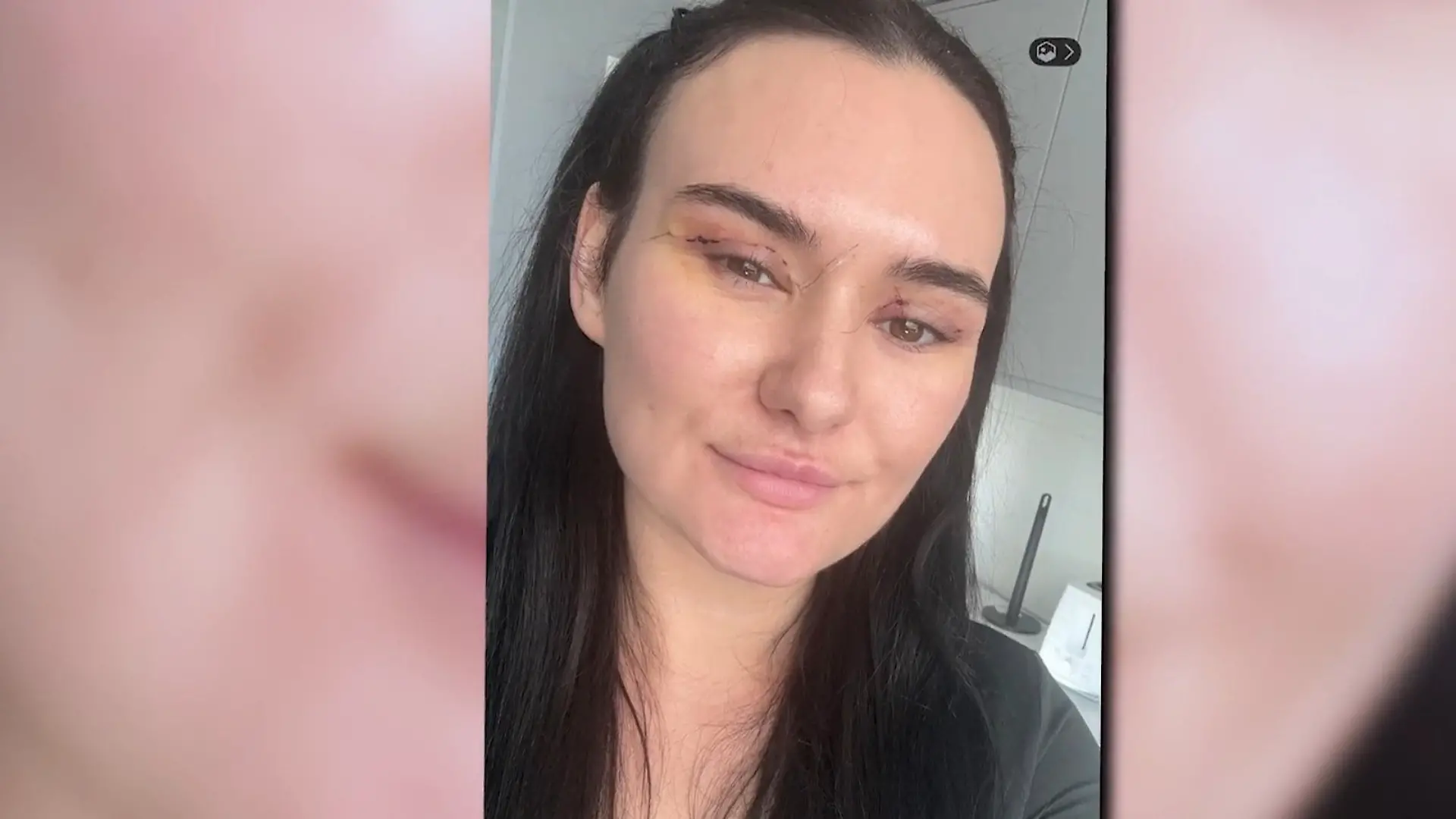 Nikita reist für günstige Lidstraffung nach Deutschland – dann beginnt der Albtraum „Aus meinen Augen lief Blut“