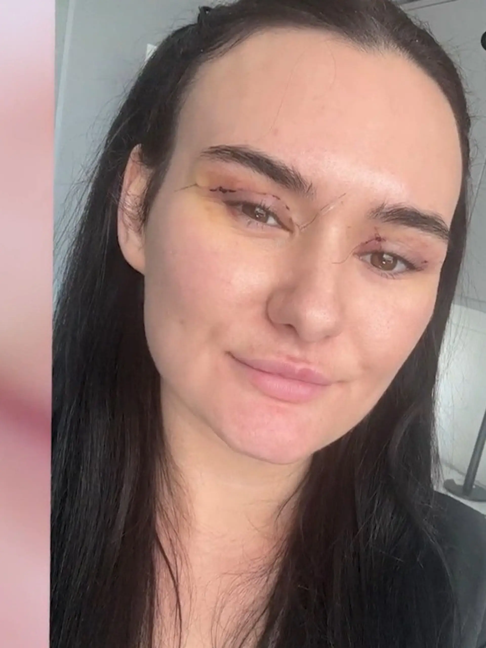 Bild zu: "Nikita reist für günstige Lidstraffung nach Deutschland – dann beginnt der Albtraum"