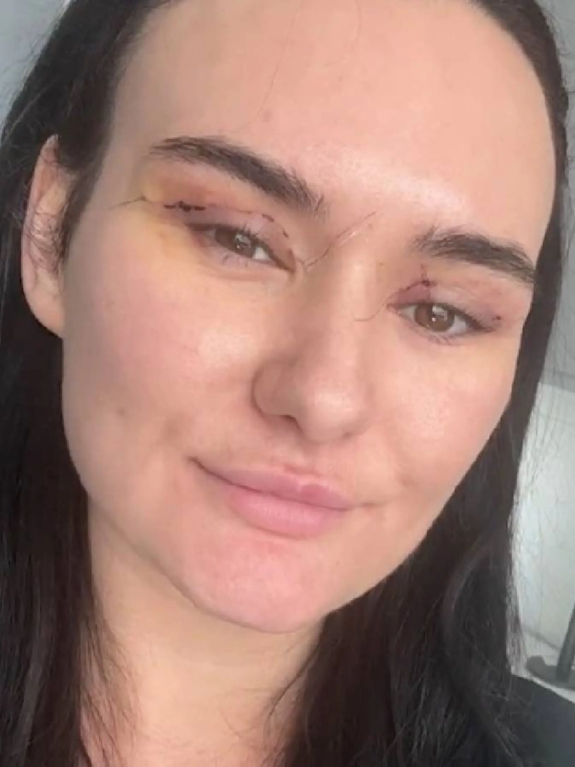 Nikita reist für günstige Lidstraffung nach Deutschland – dann beginnt der Albtraum