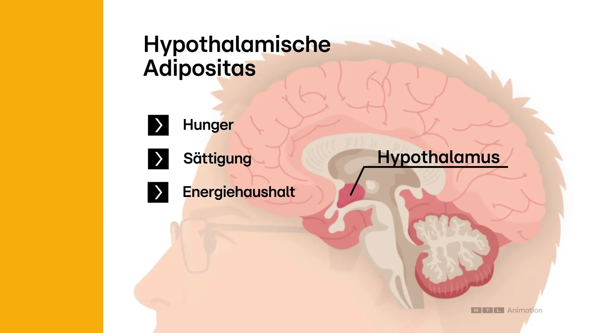Der Schock: Nach der Operation entwickelt Oliver Köthen eine hypothalamische Adipositas. Eine seltene Form der Gewichtszunahme, die durch eine Schädigung des Hypothalamus im Gehirn entsteht. Ein lebenswichtiger Teil des Zwischenhirns, der unter anderem Hunger, Sättigung und den Energiehaushalt steuert. 30-75% der Betroffenen entwickeln nach dieser speziellen OP dieses Krankheitsbild und müssen ein Leben lang damit leben.
