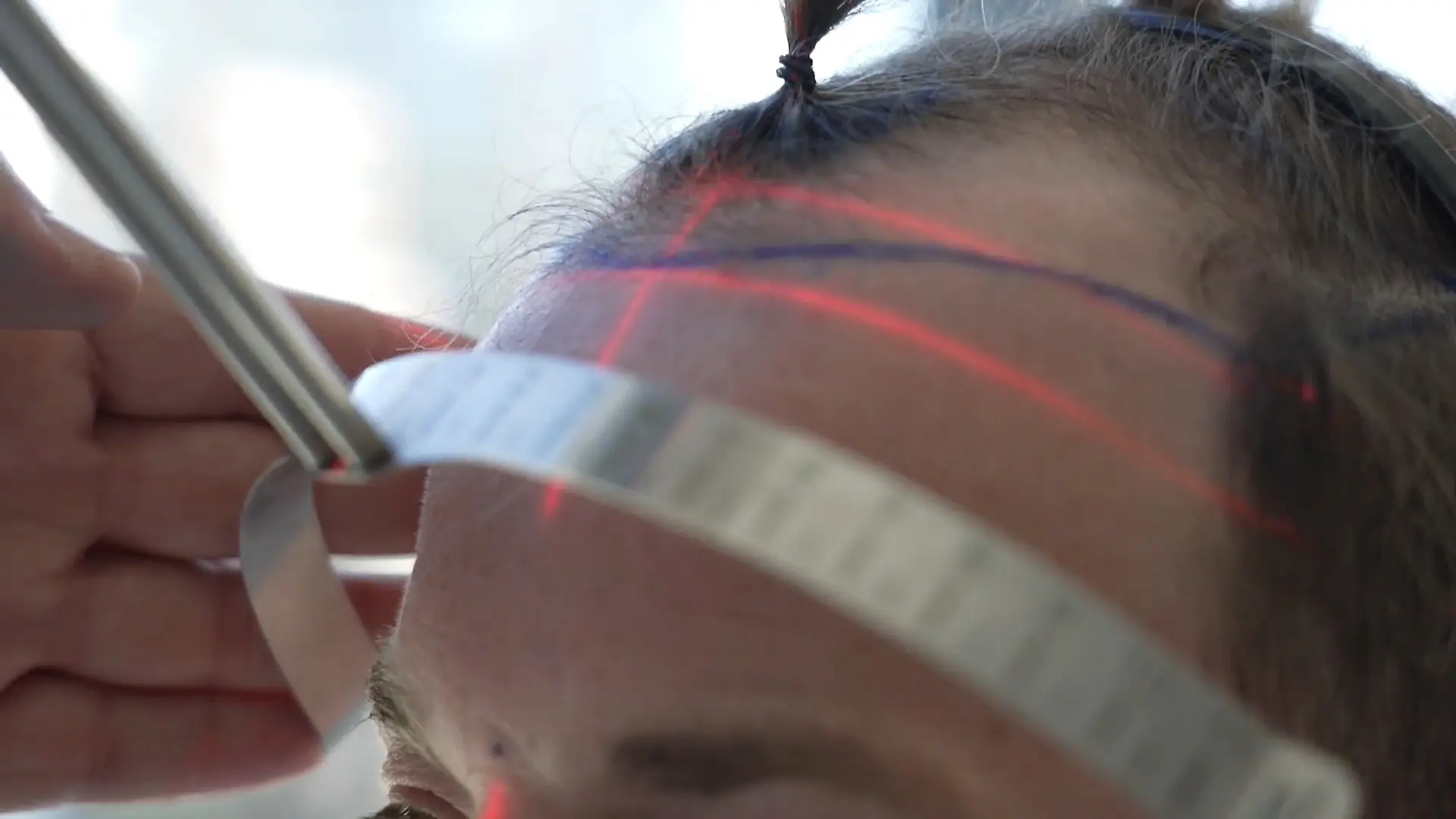 Über 10.000 neue Haare! Denny lässt sich Geheimratsecken auffüllen Haartransplantation in Istanbul