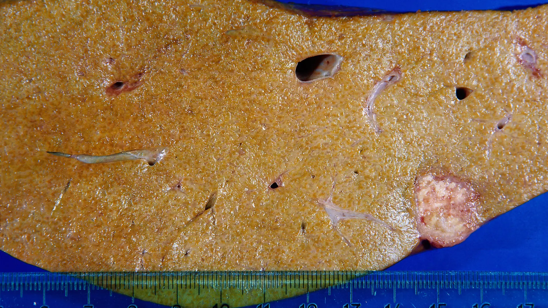 Pathologie Medizin Fettleber Leber Drüsen Präparat Längsschnitt liver pathology medicine WA Fettleber