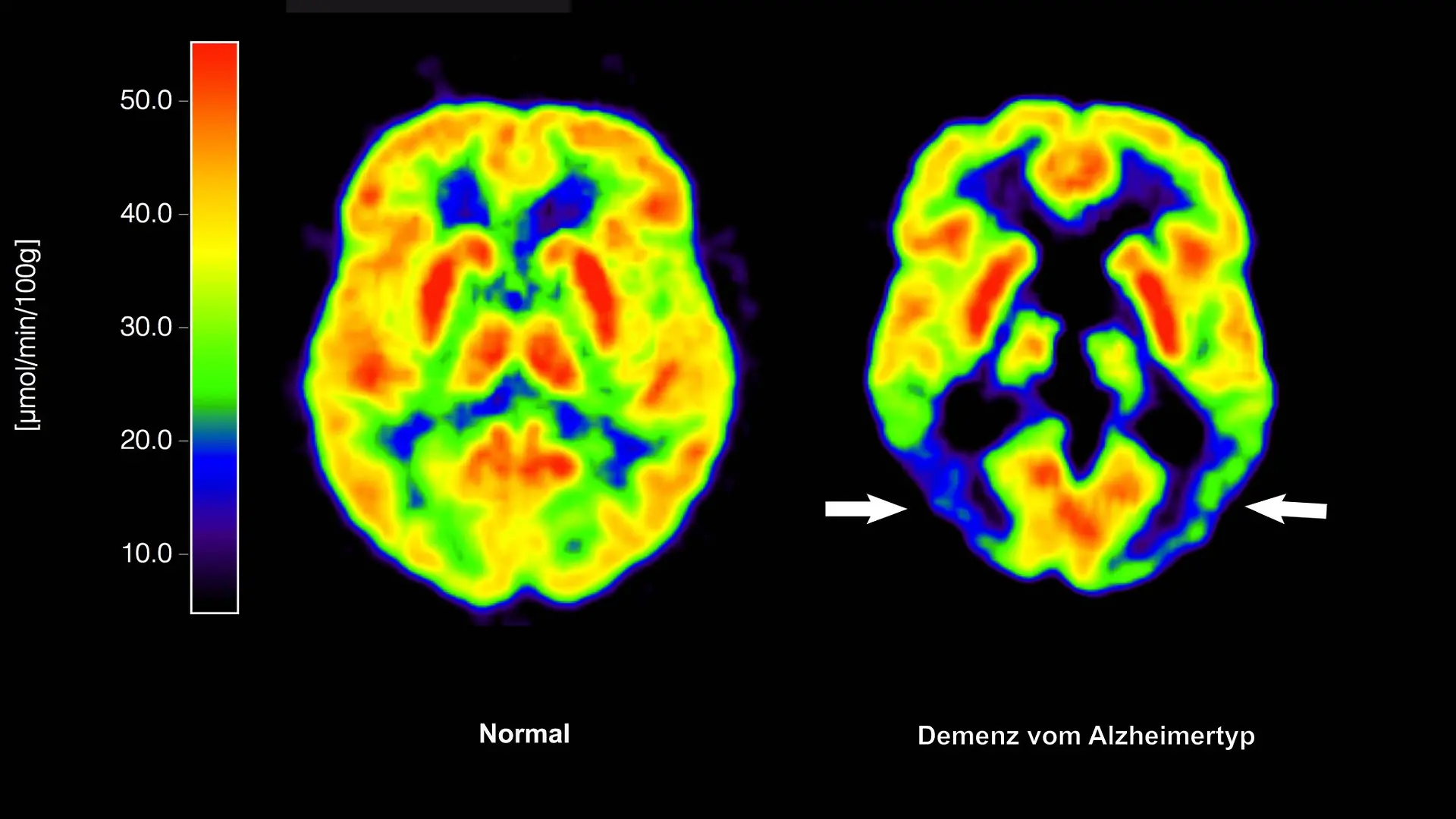 Lecanemab richtet sich gegen Amyloid-Ablagerungen im Gehirn und soll dadurch den Verlauf der Krankheit ein wenig verlangsamen. (Archivbild)