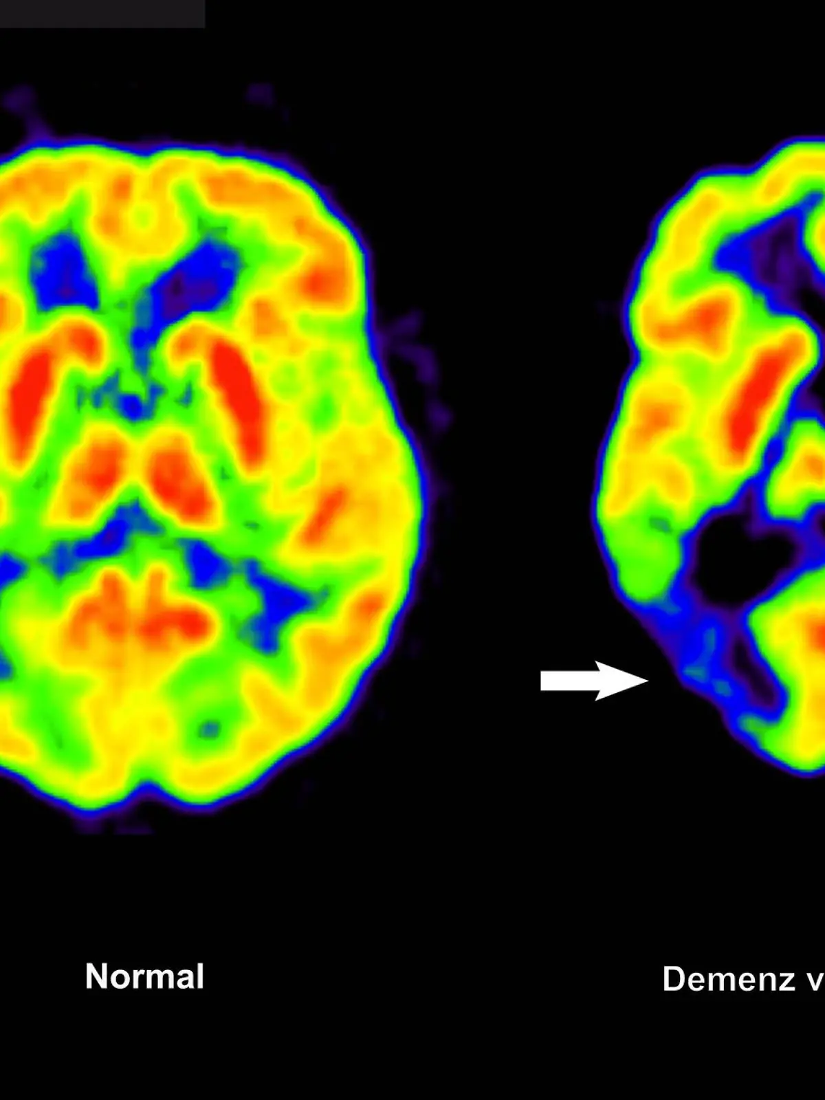 Bild zu: "Hoffnung für Millionen! EU lässt Alzheimer-Medikament zu"