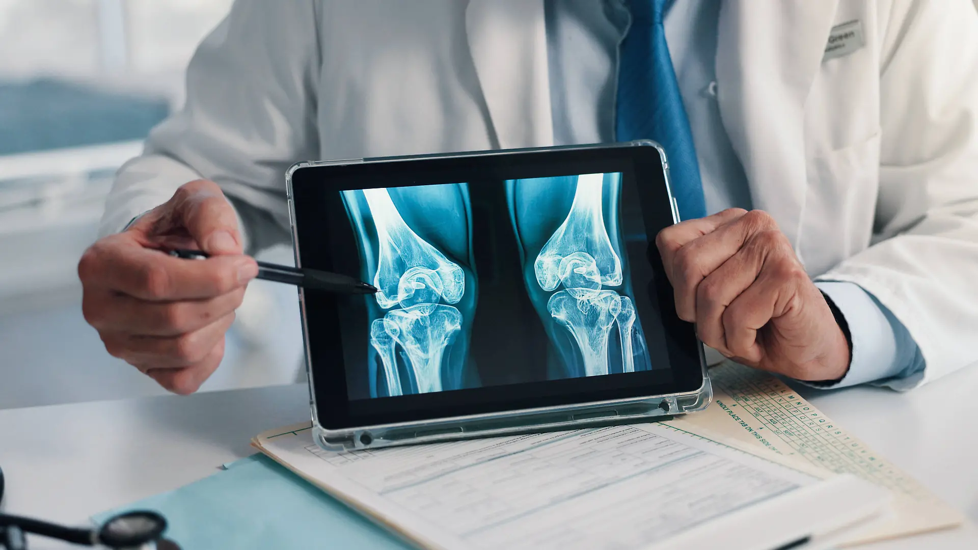 Bei Osteoporose verlieren die Knochen an Dichte und Stabilität. Dadurch werden sie poröser und können leichter brechen.