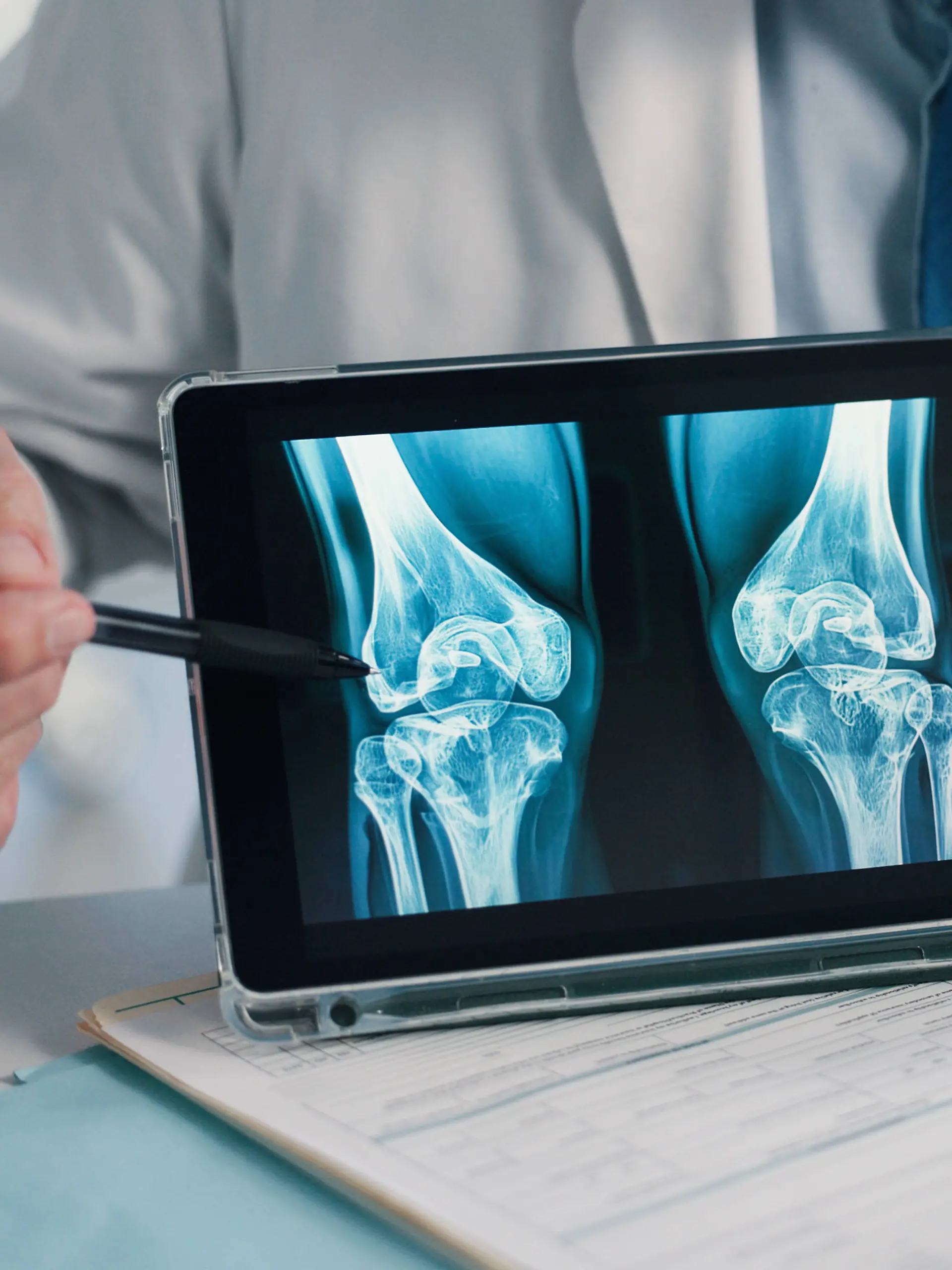Bei Osteoporose verlieren die Knochen an Dichte und Stabilität. Dadurch werden sie poröser und können leichter brechen.