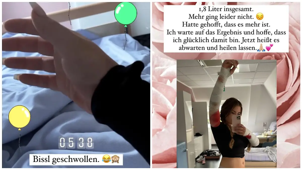 Jenny Frankhauser zeigt Fans ihren blutigen Verband nach der Lipödem-OP.