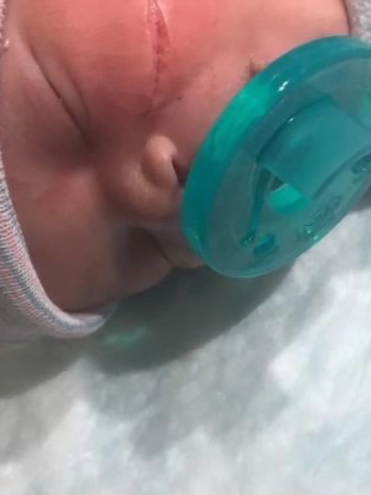 Baby bei Notkaiserschnitt verletzt