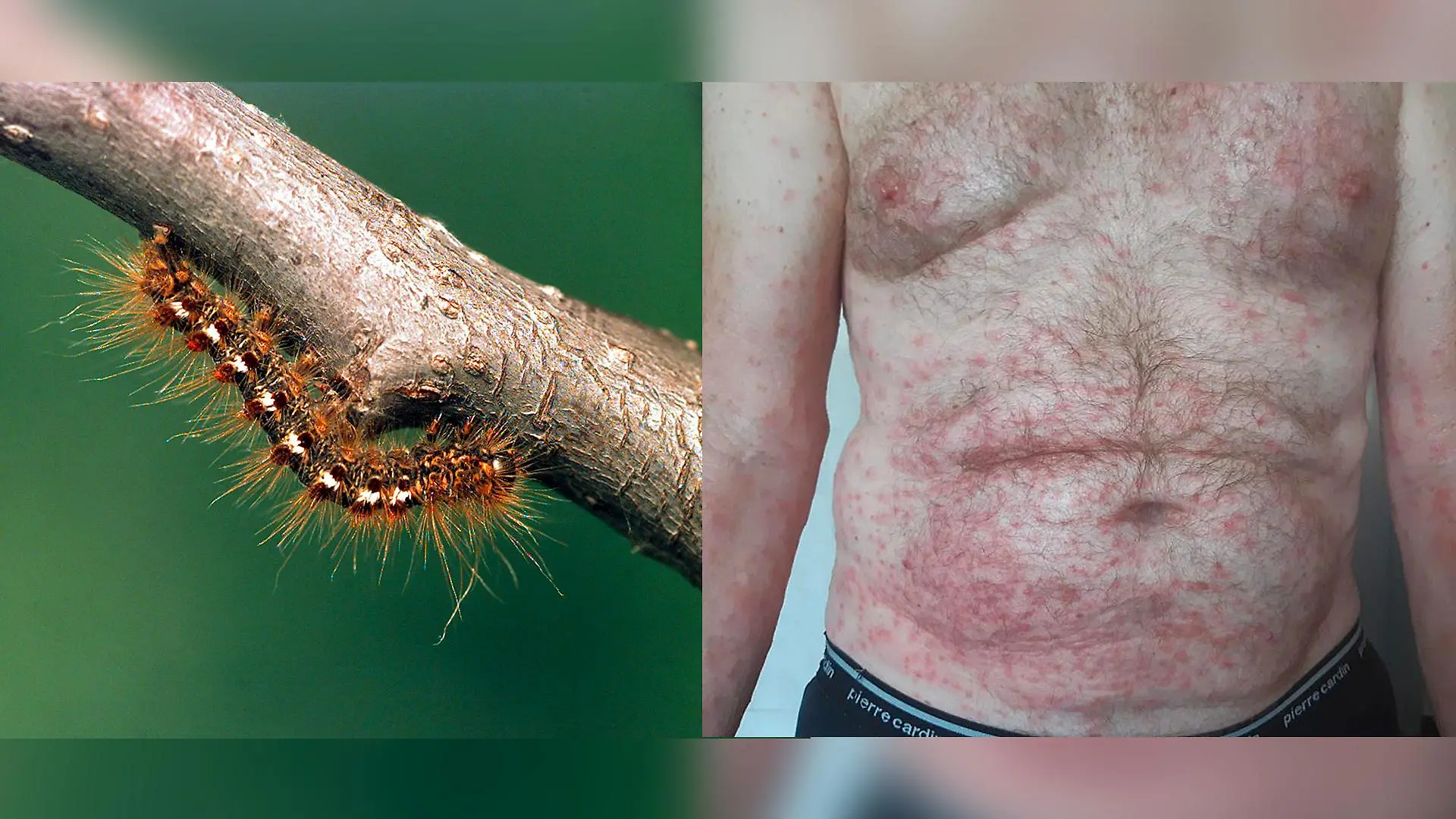 Die Goldafter Raupe kann mit ihren giftigen Härchen solche heftigen allergischen Reaktionen auslösen