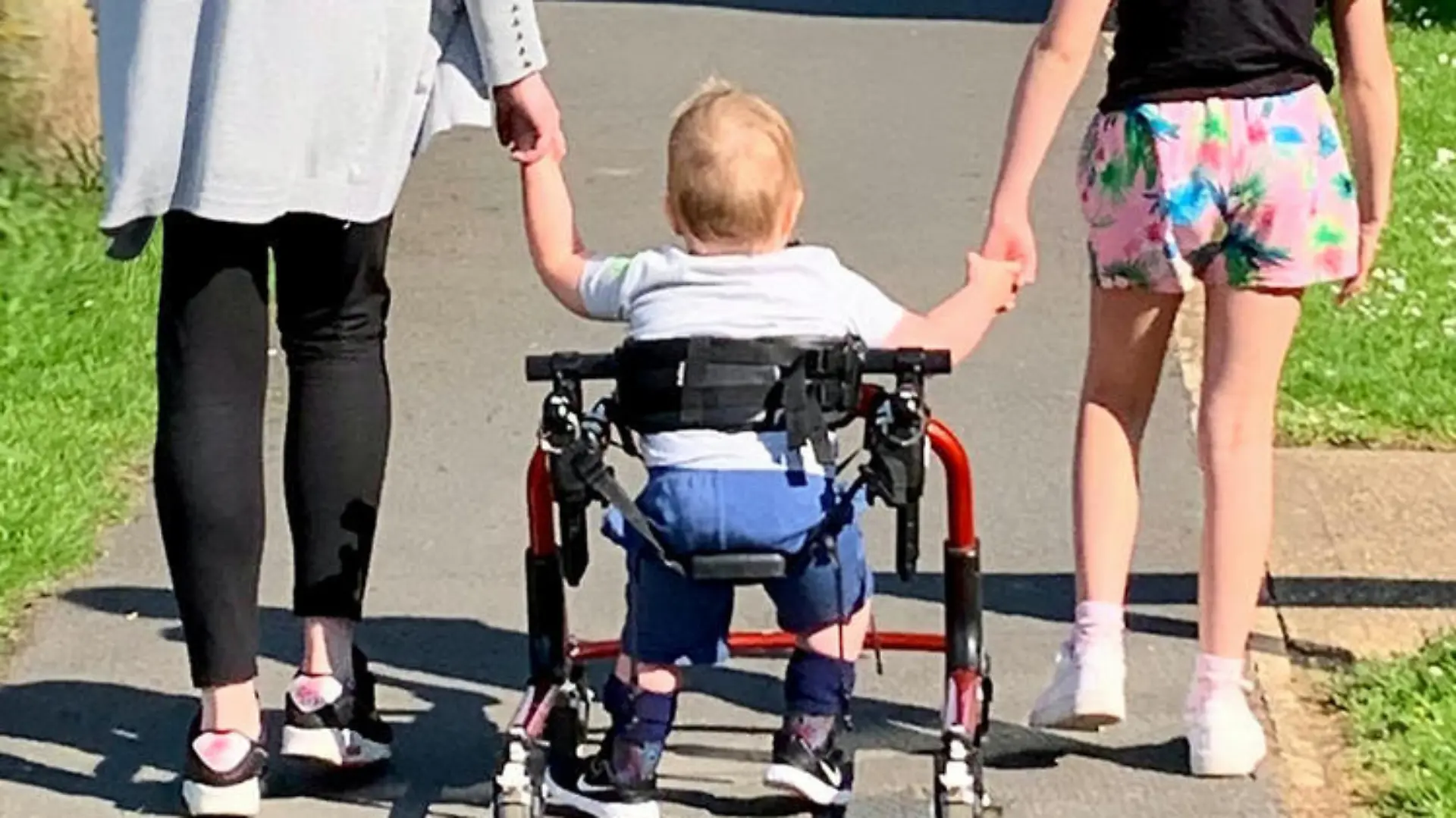 Spina Bifida