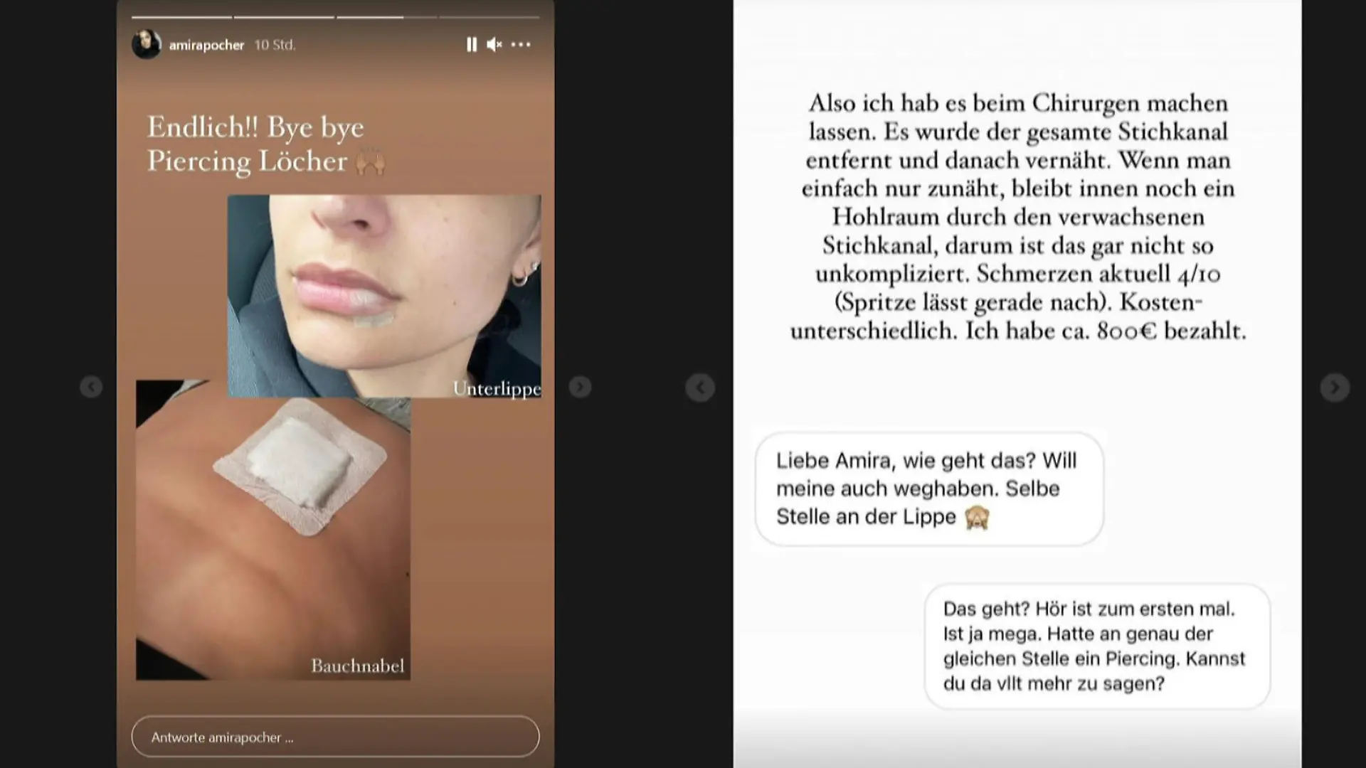 Amira Pocher ließ sich ihre Piercing-Löcher chirurgisch entfernen.