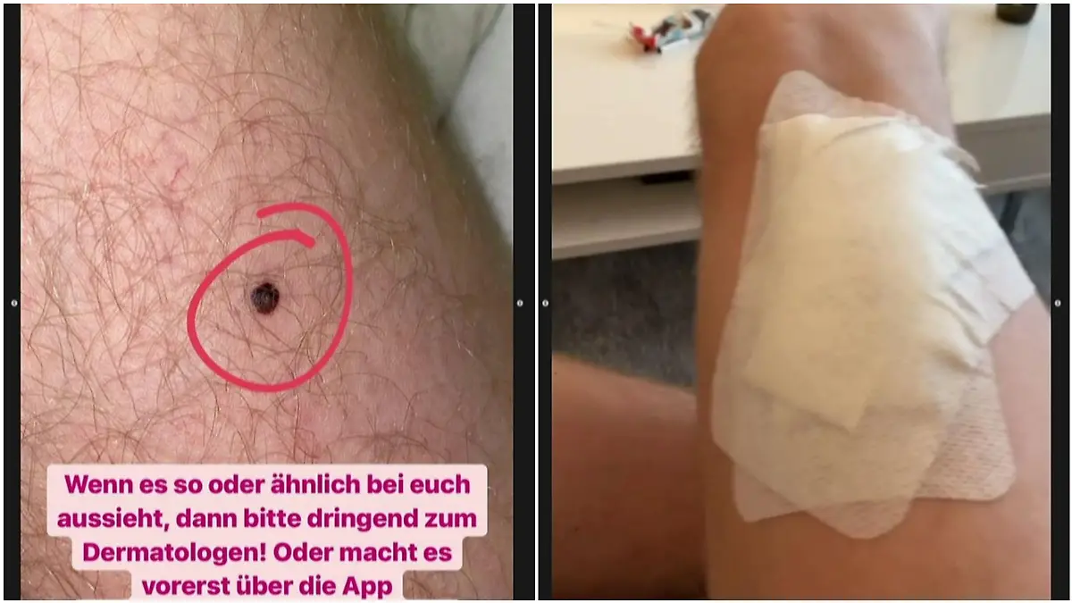 Udo Bönstrup zeigt seinen Hautkrebs bei Instagram