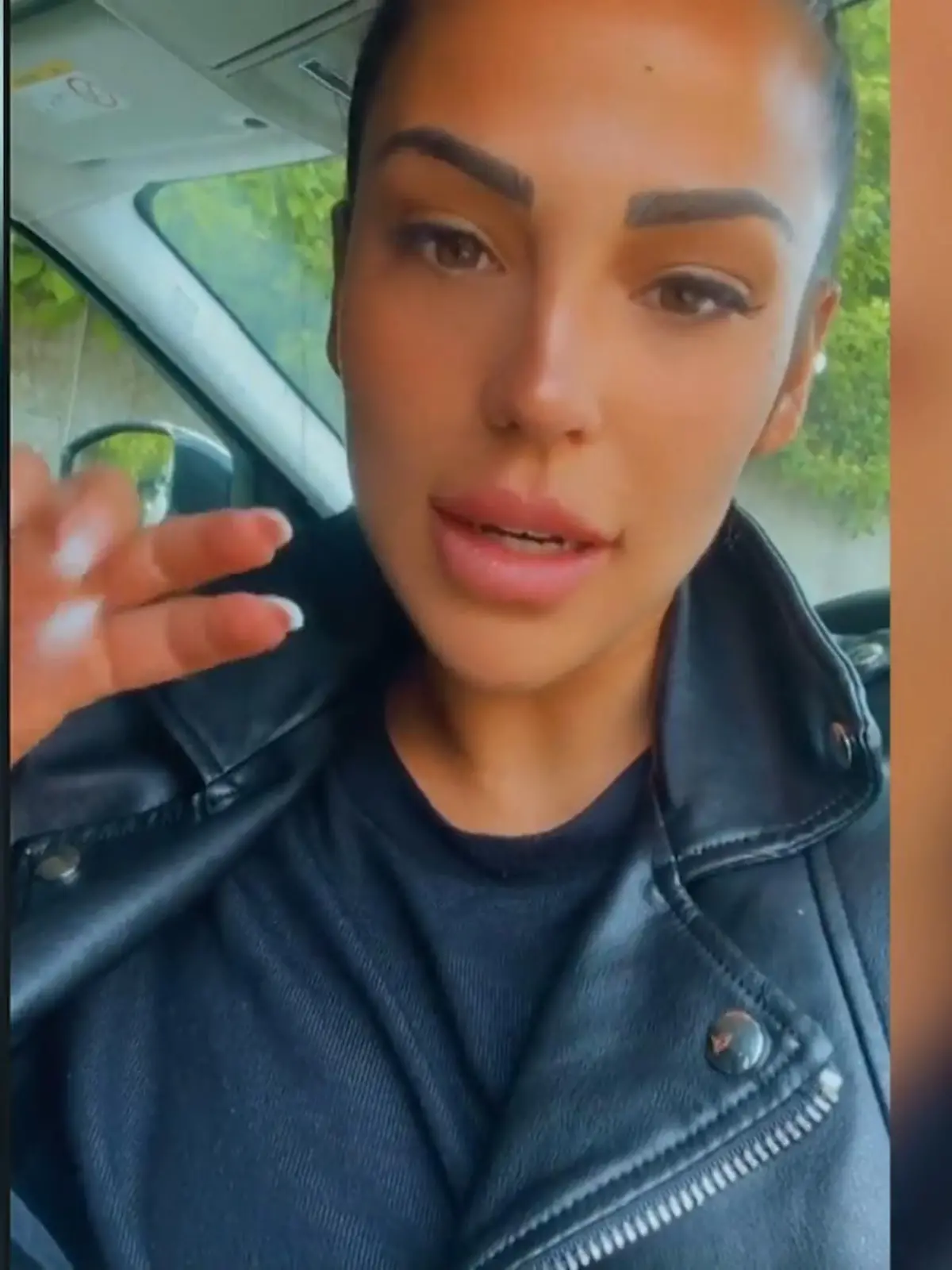 Bei Elena Miras hat sich nach ihrer Brust-OP eine Narbe entzündet.