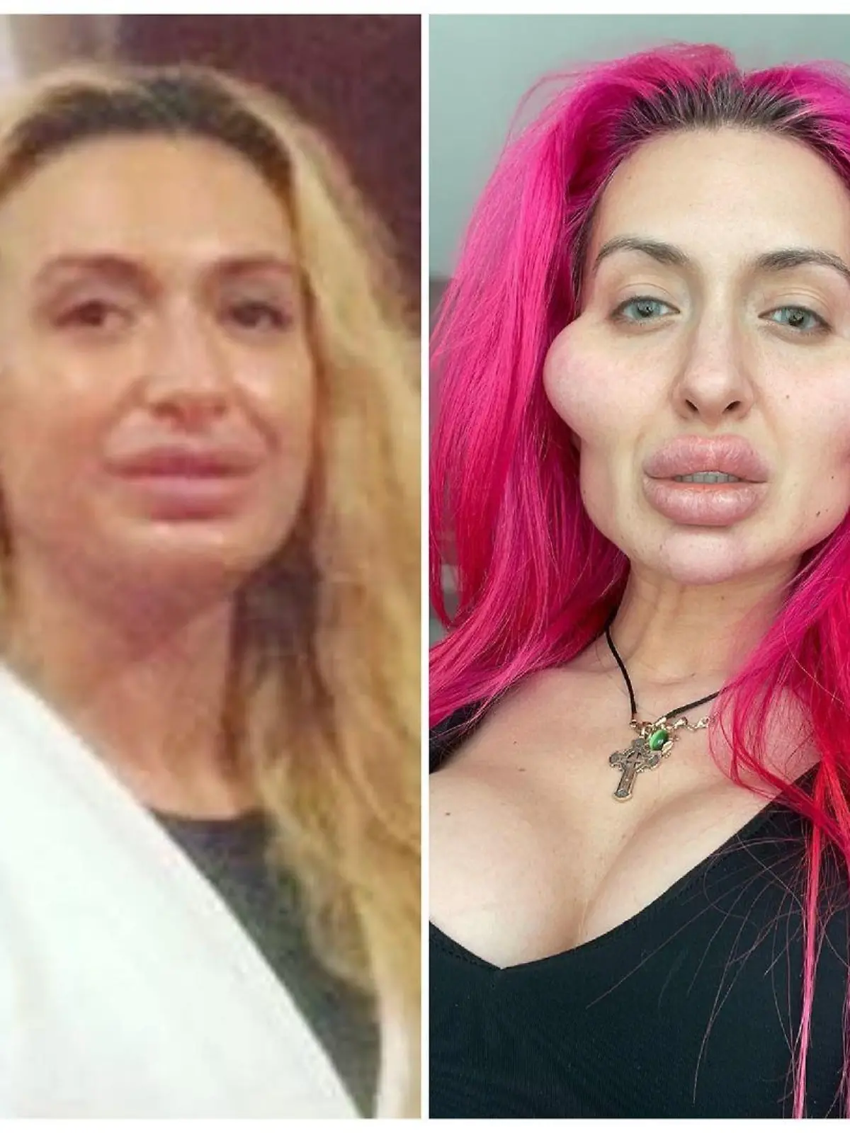 Links sieht man Anastasiia vor ihren Wangen-Injektionen, rechts sieht man sie nach unzähligen Wangen-Eingriffen.