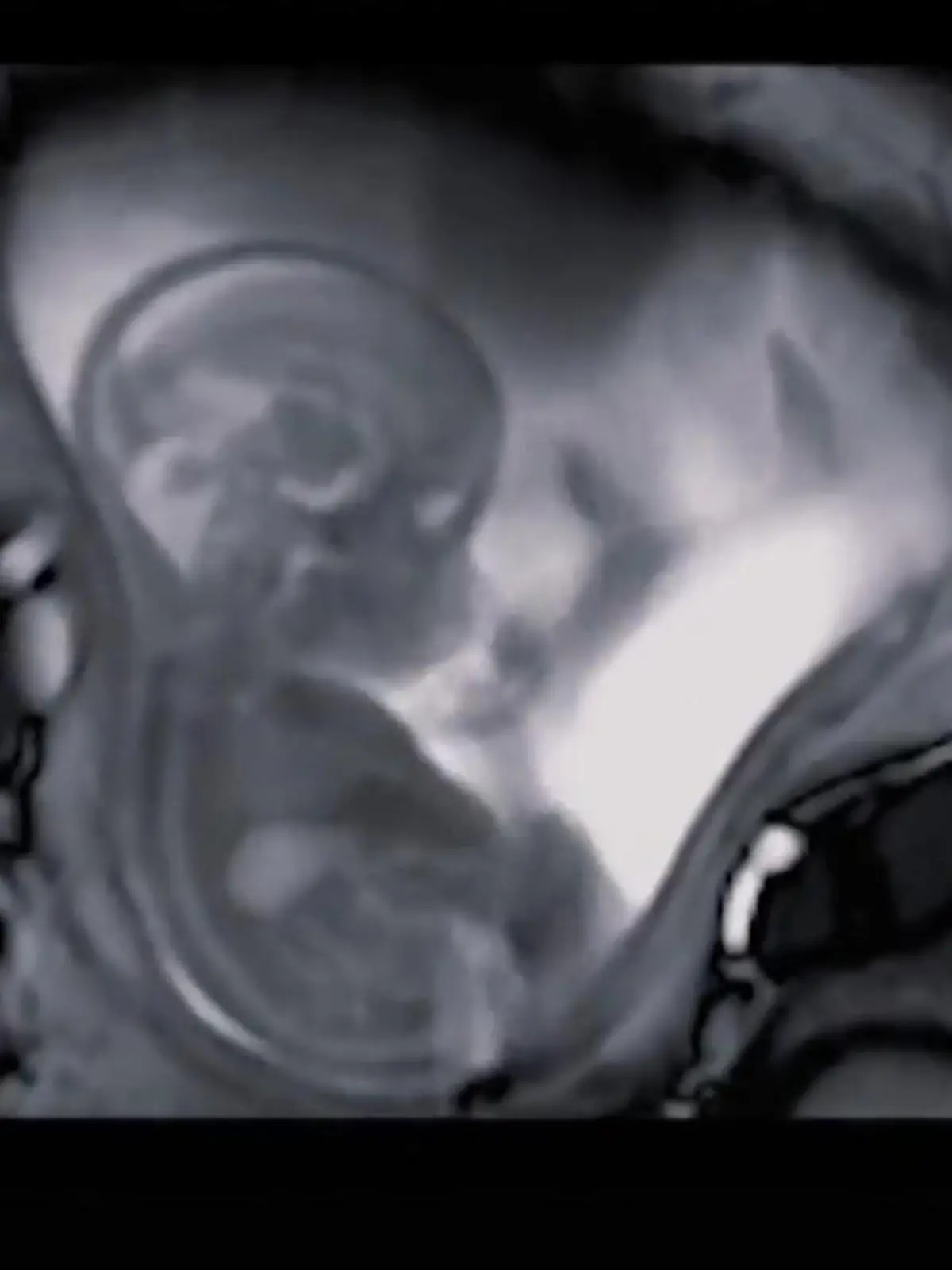 Bild zu: "Embryo macht Turnstunde in Mamas Bauch"