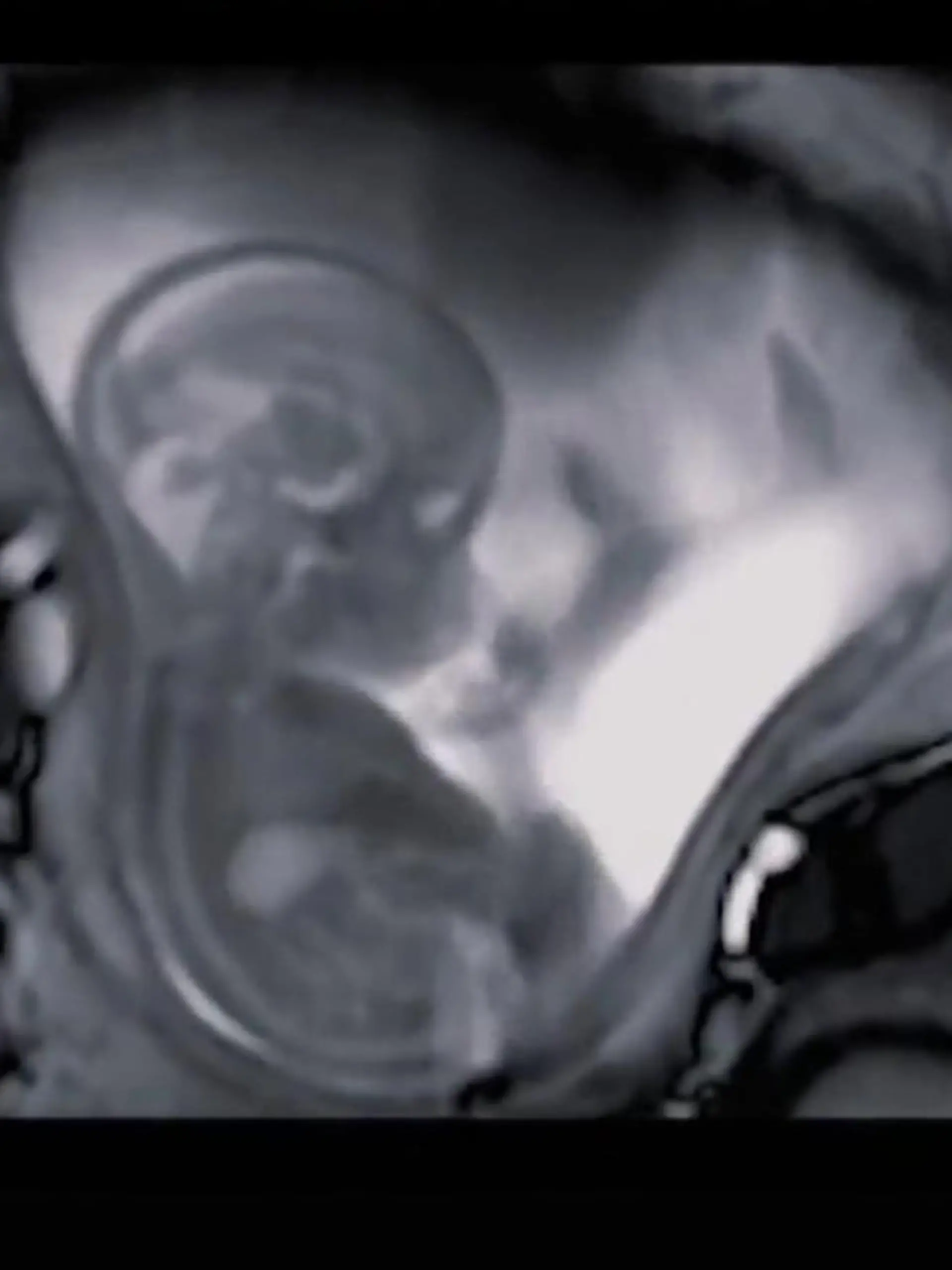 Bild zu: "Embryo macht Turnstunde in Mamas Bauch"