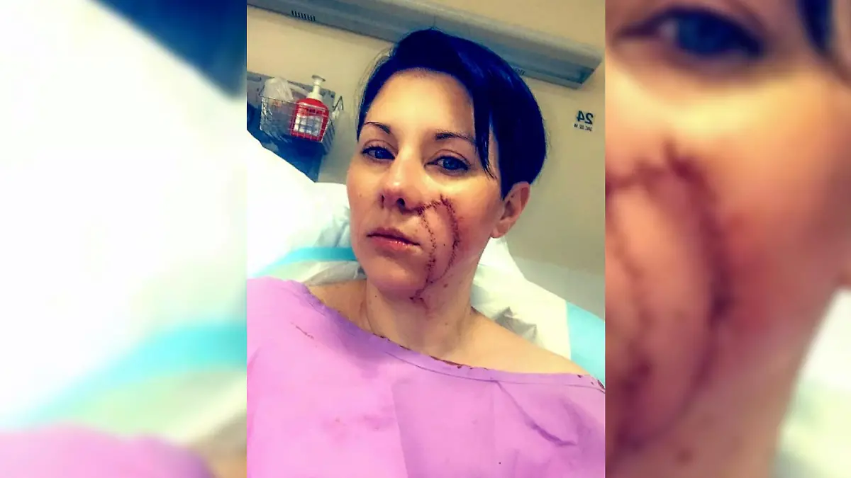 Megin Davies (40) zeigt ihre Narbe